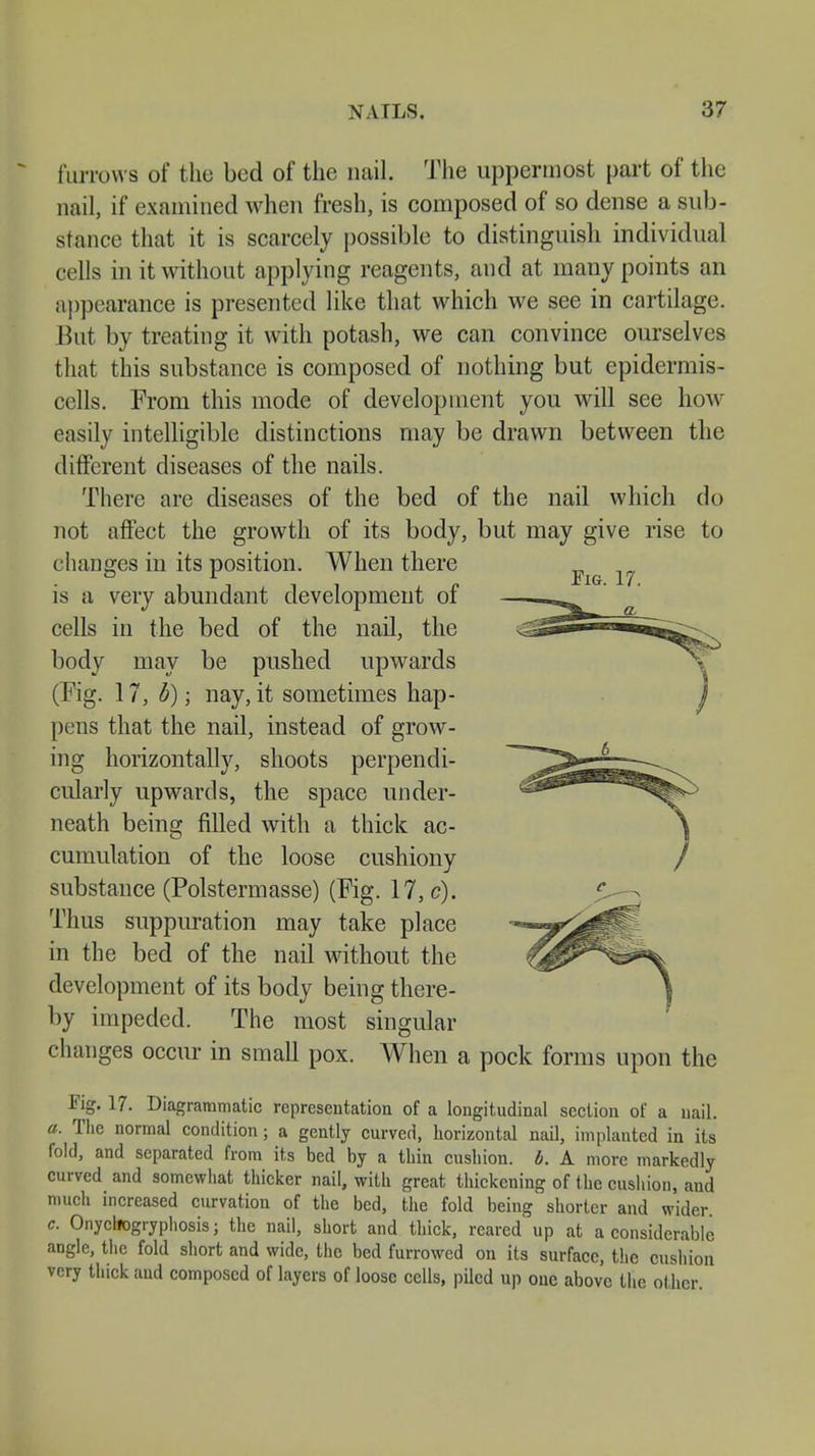 Fig. 17. furrows of the bed of the nail. The uppermost part of the nail, if examined when fresh, is composed of so dense a sub- stance that it is scarcely possible to distinguish individual cells in it without applying reagents, and at many points an appearance is presented like that which we see in cartilage. But by treating it with potash, we can convince ourselves that this substance is composed of nothing but epidermis- cells. From this mode of development you will see how easily intelligible distinctions may be drawn between the different diseases of the nails. There are diseases of the bed of the nail which do not affect the growth of its body, but may give rise to changes in its position. When there is a very abundant development of cells in the bed of the nail, the body may be pushed upwards (Fig. 17, b); nay, it sometimes hap- pens that the nail, instead of grow- ing horizontally, shoots perpendi- cularly upwards, the space under- neath being filled with a thick ac- cumulation of the loose cushiony substance (Polstermasse) (Fig. 17, c). Thus suppuration may take place in the bed of the nail without the development of its body being there- by impeded. The most singular changes occur in small pox. When a pock forms upon the Fig. 17. Diagrammatic representation of a longitudinal section of a nail. a. The normal condition; a gently curved, horizontal nail, implanted in its fold, and separated from its bed by a thin cushion, b. A more markedly curved and somewhat thicker nail, with great thickening of the cushion, and much increased curvation of the bed, the fold being shorter and wider. c. Onycliogiyphosis; the nail, short and thick, reared up at a considerable angle, the fold short and wide, the bed furrowed on its surface, the cushion very thick and composed of layers of loose cells, piled up one above the other