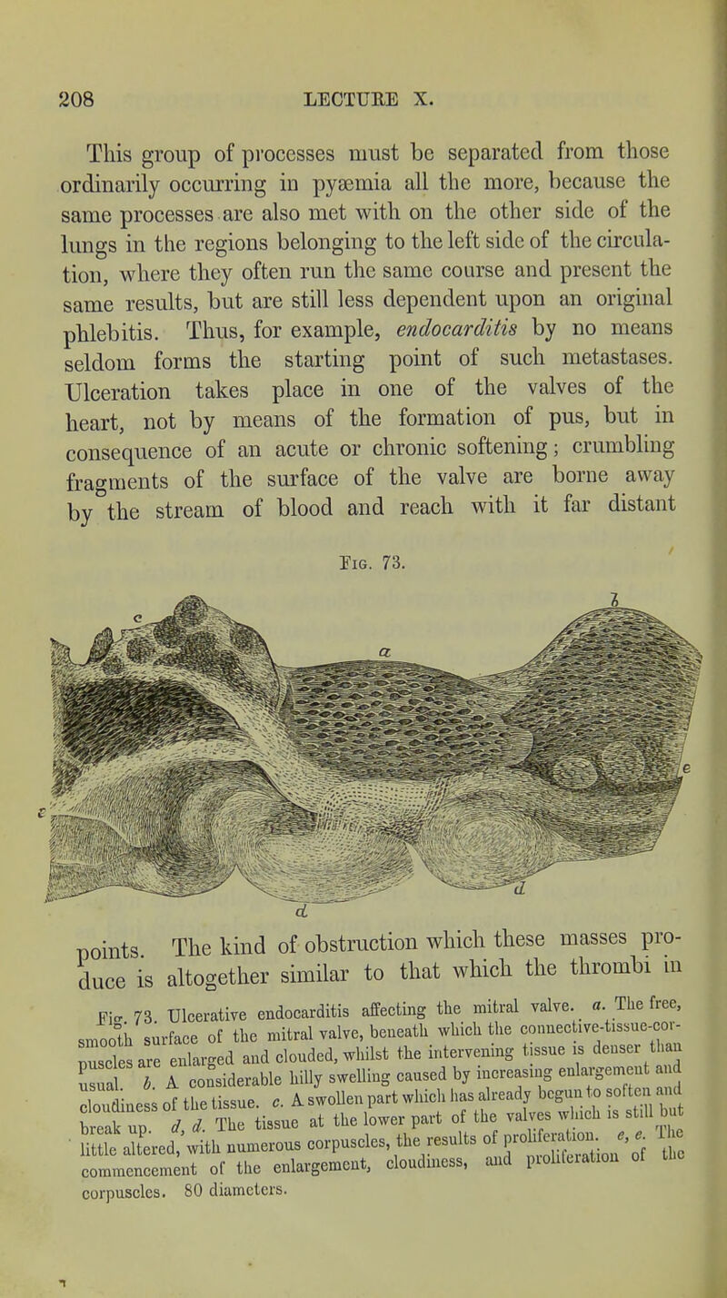 This group of processes must be separated from those ordinarily occurring in pysemia all the more, because the same processes are also met with on the other side of the lungs in the regions belonging to the left side of the circula- tion, where they often run the same course and present the same results, but are still less dependent upon an original phlebitis. Thus, for example, endocarditis by no means seldom forms the starting point of such metastases. Ulceration takes place in one of the valves of the heart, not by means of the formation of pus, but in consequence of an acute or chronic softening; crumbling fragments of the surface of the valve are borne away by the stream of blood and reach with it far distant Pig. 73. points The kind of obstruction which these masses pro- duce is altogether similar to that which the thrombi in Ei~ 73 Ulcerative endocarditis affecting the mitral valve, a. The free, smoolh surface of the mitral valve, beneath which the connec ive-tissne-cor puselesare enlarged and clouded, whilst the intervening tissue is denser than usua 7 1 considerable hilly swelling caused by increasing enlargement and \ V P«nftl.p tissue e A. swollen part which has already begun to soften and tZl up Tl CU» at the iLer part of the valves which is still u ' U lc altered w th numerous corpuscles, the results of proliferation e, e. he coleSenr^ the enlargement, cloudiness, and proliferation of the corpuscles. 80 diameters.