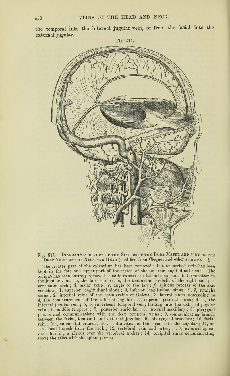 the temporal into the internal jugular vein, or from the facial into the external jugular. Fig. 311. Fig. 311.—Diagrammatic view op the Sinuses op the Dura Mater and some op the Deep Veins op the Neck and Head (modified from Cloquet and other sources). 4 The greater part of the calvarium has been removed ; but an arched strip has been kept in the fore and upper part of the region of the superior longitudinal sinus. The occiput has been entirely removed so as to expose the lateral sinus and its termination in the jugular vein, a, the falx cerebri; 6, the tentorium cerebelli of the right side; c, zygomatic arch ; d, malar bone ; e, angle of the jaw; /, spinous process of the axis vertebra; 1, superior longitudinal sinus ; 2, inferior longitudinal sinus ; 2, 3, straight sinus ; 2', internal veins of the brain (veins of Galen); 3, lateral sinus, descending to 4, the commencement of the internal jugular ; 3', superior petrosal sinus ; 4, 4, the internal jugular vein ; 5, 5, superficial temporal vein, leading into the external jugular vein ; 6, middle temporal ; 7, posterior auricular ; 8, internal maxillary ; 8', pterygoid plexus and communications with the deep temporal veins ; 9, communicating branch between the facial, temporal and external jugular ; 9', pharyngeal branches; 10, facial vein ; 10', submental branch ; 10, continuation of the facial into the angular; 11, an occasional branch from the neck; 12, vertebral vein and artery; 13, external spinal veins forming a plexus over the vertebi’al arches ; 14, occipital sinus communicating above the atlas with the spinal plexus.