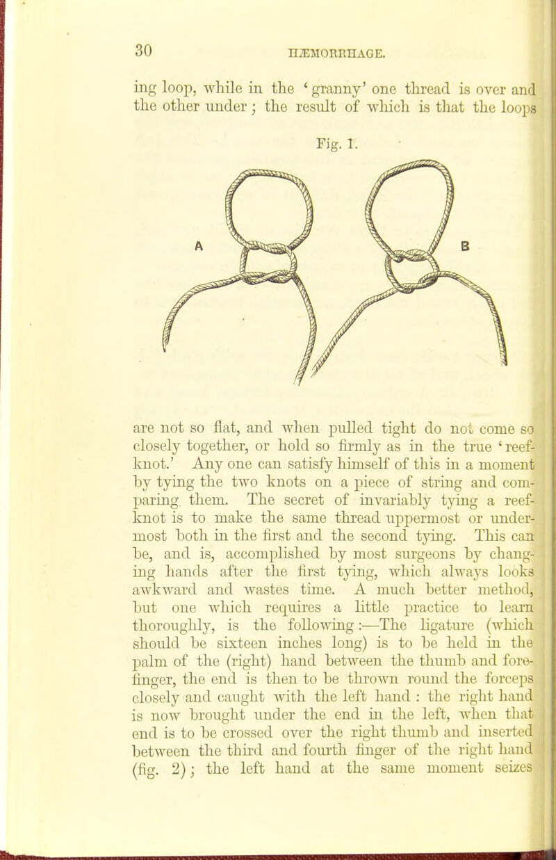 ing loop, while in the 'granny' one thread is over and the other under; the result of which is that the loops Fig. 1. are not so flat, and when pulled tight do not come so closely together, or hold so firmly as in the true ' reef- knot.' Any one can satisfy himself of this in a moment by tying the two knots on a j)iece of string and com- paring, them. The secret of iuA^ariably tjang a reef- knot is to make the same thread uj^permost or under- most both in the first and the second tying. This can be, and is, accomplished by most surgeons by chang- ing hands after the first tying, which always looks awkward and wastes time. A much better method, but one which requires a little practice to learn thoroughly, is the following:—The ligature (which should be sixteen inches long) is to be held in the palm of the (right) hand between the thumb and fore- finger, the end is then to be thro^ra round the forceps closely and caught with the left hand : the right hand is now brought under the end in the left, when tliat end is to be crossed over the right tlnimb and inserted between the thii-d and fourth finger of the right hand (fig. 2); the left hand at the same moment seizes