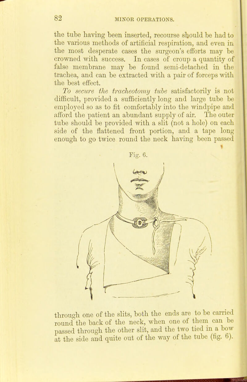 the tube having been inserted, recourse should be liad to the various methods of artiiicial respiration, and even in the most desperate cases the surgeon's efforts may be crowned with success. In cases of croup a quantity of false membrane may be found semi-detached in the trachea, and can be extracted with a pair of forceps \vith the best effect. To secure the tracheotomy tube satisfactorily is not difficult, provided a sufficiently long and large tube be employed so as to fit comfortably into the windpipe and afford the patient an abundant supply of air. The outer tube should be provided with a slit (not a hole) on each side of the flattened front portion, and a tape long enough to go twice round the neck having been passed Fig. 6. through one of the slits, both the ends are to be carried roundthe back of the neck, when one of them can be passed through the other slit, and the two tied in a bow at the side and quite out of the way of the tube (fig. 6).