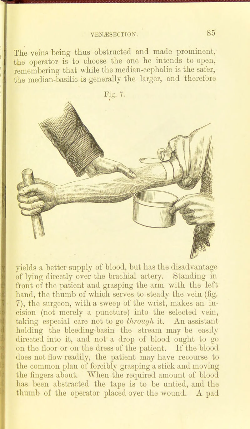 VENiESEGTION. The veins being thus obstructed and made prominent, the operator is to choose the one he intends to open, remembering that while the median-cephalic is the safer, the median-basilic is generally the larger, and therefore Fig. 7. yields a better supply of blood, but has the disadvantage of lying directly over the brachial artery. Standing in front of the patient and grasping the arm with the left hand, the thumb of which serves to steady the vein (fig. 7), the surgeon, with a sweep of the wrist, makes an in- cision {not merely a puncture) into the selected vein, taking especial care not to go through it. An assistant holding the bleeding-basin the stream may be easily directed into it, and not a drop of blood ought to go on the floor or on the dress of the patient. If the blood does not flow readUy, the patient may have recourse to the common plan of forcibly grasping a stick and moving the fingers about. When the required amount of blood has been abstracted the tape is to be untied, and the thumb of the operator placed over the wound. A pad