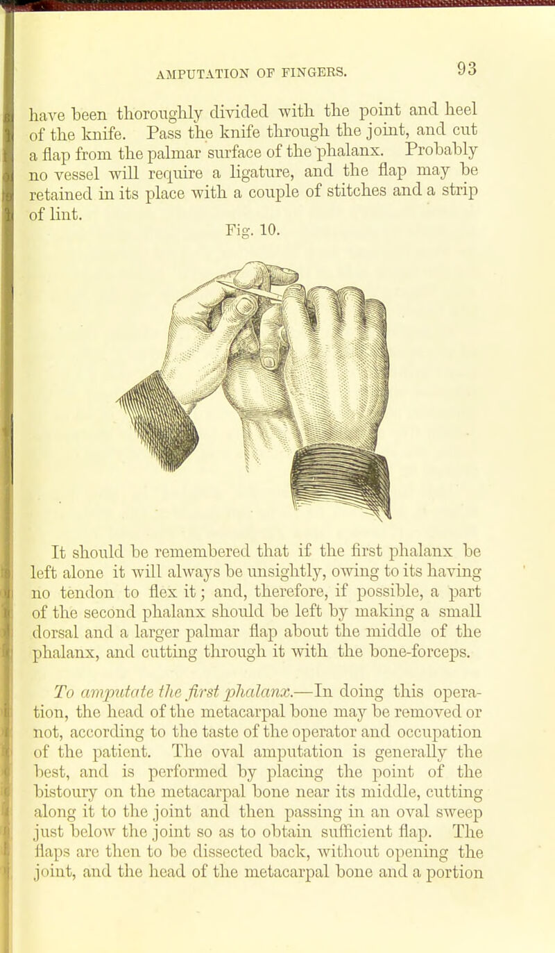 AMPUTATION OF FINGERS. haA^e been thoroughly divided with the point and heel of the knife. Pass the knife through the joint, and cvit a flap from the palmar siu^ace of the phalanx. Prohahly no vessel will require a ligature, and the flap may he retained in its place with a couple of stitches and a strip of lint. Fig. 10. It should he remembered that if the first phalanx be left alone it will always be unsightly, owing to its having no tendon to flex it; and, therefore, if possible, a part of the second phalanx shoidd be left by making a small dorsal and a larger palmar flap about the middle of the phalanx, and cutting through it with the bone-forceps. To amputate the first ijlialanx.—In doing this opera- tion, the head of the metacarpal bone may be removed or not, according to the taste of the operator and occupation of the patient. The oval amputation is generally the best, and is performed by placing the point of the bistoury on the metacarpal bone near its middle, cutting along it to the joint and then passing in an oval sweep just below the joint so as to obtain sufficient flap. The flaps are then to be dissected back, without opening the joint, and the head of the metacarpal bone and a portion