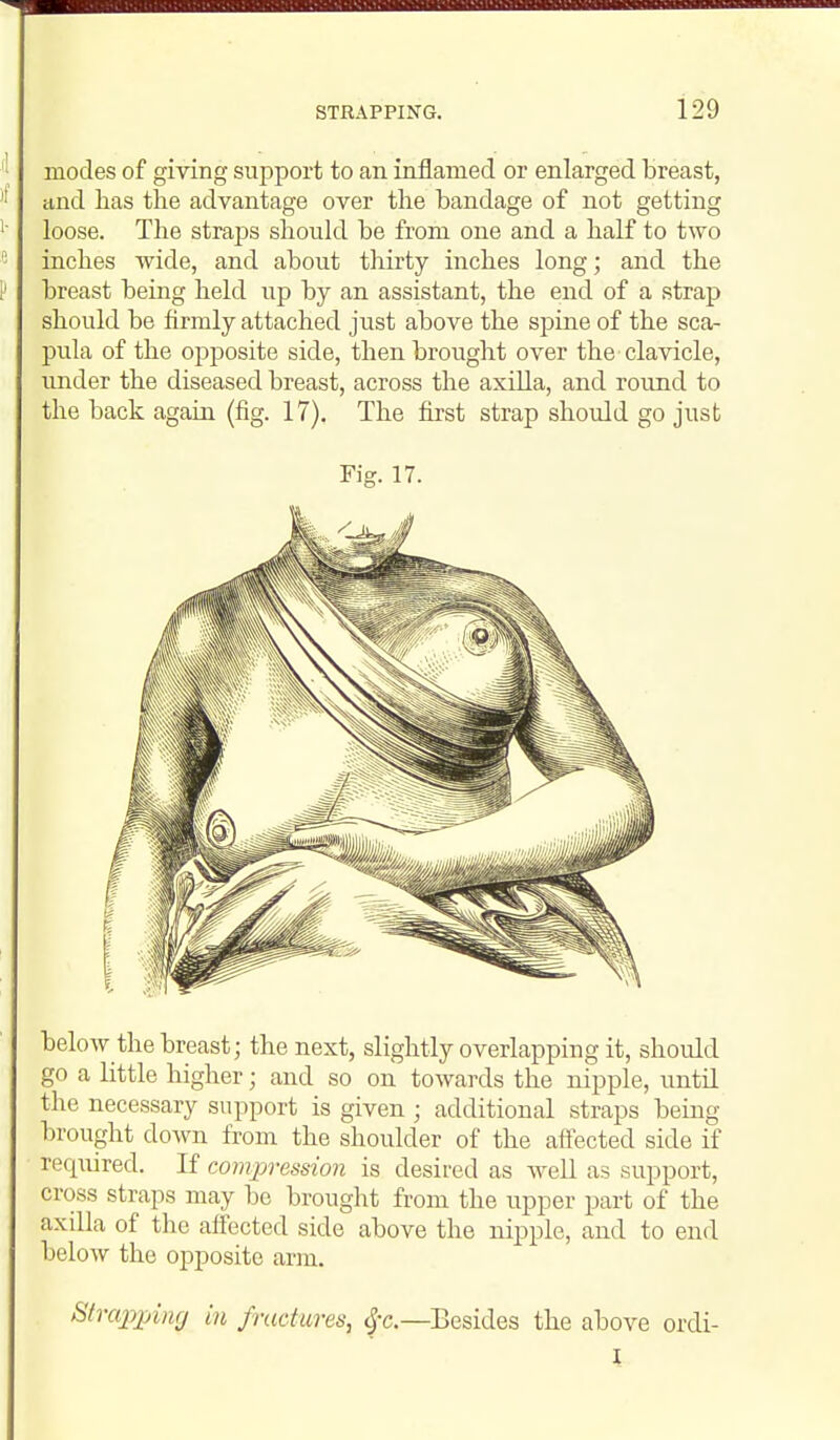 modes of giving support to an inflamed or enlarged breast, and has the advantage over the bandage of not getting loose. The straps shoukl be from one and a half to two inches wide, and about thirty inches long; and the breast being held up by an assistant, the end of a strap should be firmly attached just above the spine of the sca- pula of the opposite side, then brought over the clavicle, under the diseased breast, across the axUla, and round to the back again (fig. 17). The first strap should go just Fig. 17. below the breast; the next, slightly overlapping it, should go a little higher; and so on towards the nipple, untH the necessary support is given ; additional straps being brought down from the shoulder of the afi'ected side if required. If compression is desired as well as support, cross straps may be brought from the upper part of the axilla of the aftected side above the nipple, and to end below the opposite arm. Strapxjing in fractures, ^t.—Besides the above ordi- l