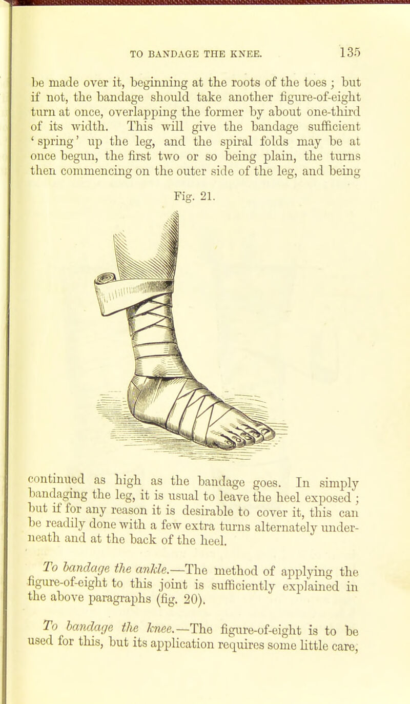 be made over it, beginning at the roots of the loes ; but if not, the bandage shoidd take another figure-of-eight turn at once, overlapping the former by about one-tliird of its width. This will give the bandage sufficient ' spring' up the leg, and the spiral folds may be at once begun, the first two or so being plain, the turns then commencing on the outer side of the leg, and being Fig. 21. continued as high as the bandage goes. In simply bandaging the leg, it is usual to leave the heel exposed ; but if for any reason it is desirable to cover it, this can be readily done with a few extra tm-ns alternately under- neath and at the back of the heel. To bandage the ankle.—The method of applying the figure-of-eight to this joint is sufficiently explained in the above paragraphs (fig. 20). To bandage the Tcnee.—Th.Q figure-of-eight is to be used for this, but its application requires some little care;