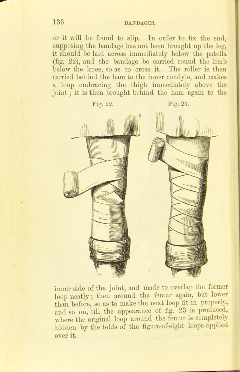 or it will be found to slip. In order to fix the end, supposing the bandage has not been brought up the leg, it should be laid across immediately below the patella (fig. 22), and the bandage be carried round the limb below the knee, so as to cross it. The roller is then carried behind the ham to the inner condyle, and makes a loop embracing the thigh immediately above the joint; it is then brought beliind the ham again to the Fig. 22. Fig. 23. inner side of the joint, and made to overlap the former loop neatly; then around the femur again, but lower than before, so as to make the next loop fit in properly, and so on, till the appeai-ance of fig. 23 is produced, where the original loop around the femur is completely hidden by the folds of the figure-of-eight loops appUed over it.