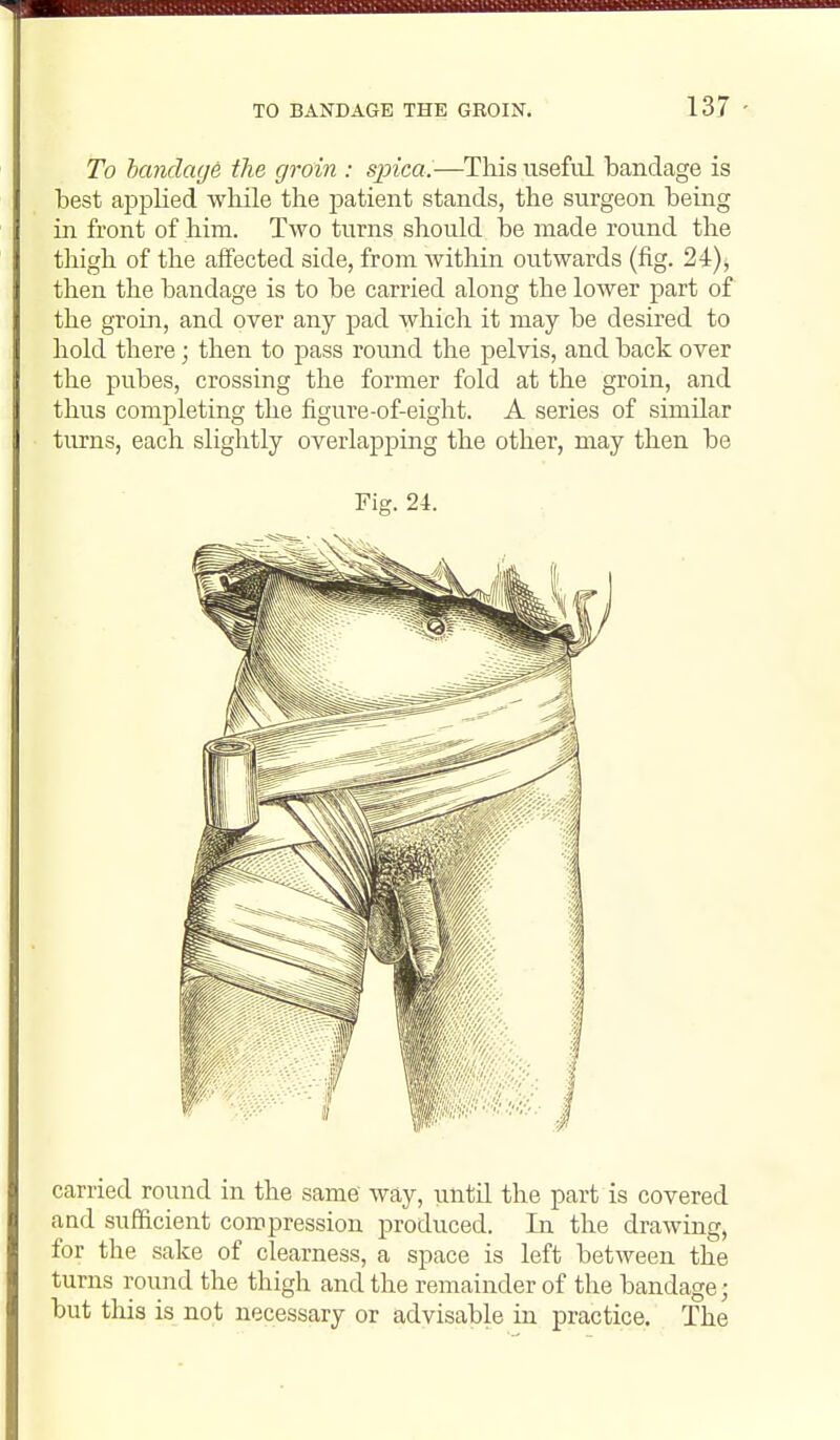 To bandage the groin : spica.—This useful bandage is best appHed wbile the patient stands, the surgeon being in front of him. Two turns should be made round the thigh of the affected side, from within outwards (fig. 24), then the bandage is to be carried along the lower part of the groin, and over any pad which it may be desired to hold there; then to jDass round the pelvis, and back over the pubes, crossing the former fold at the groin, and thus completing the figure-of-eight. A series of similar turns, each slightly overlapping the other, may then be Fig. 24. carried round in the same' way, imtil the part is covered and sufficient compression produced. In the drawing, for the sake of clearness, a space is left between the turns round the thigh and the remainder of the bandage; but this is not necessary or advisable in practice. The