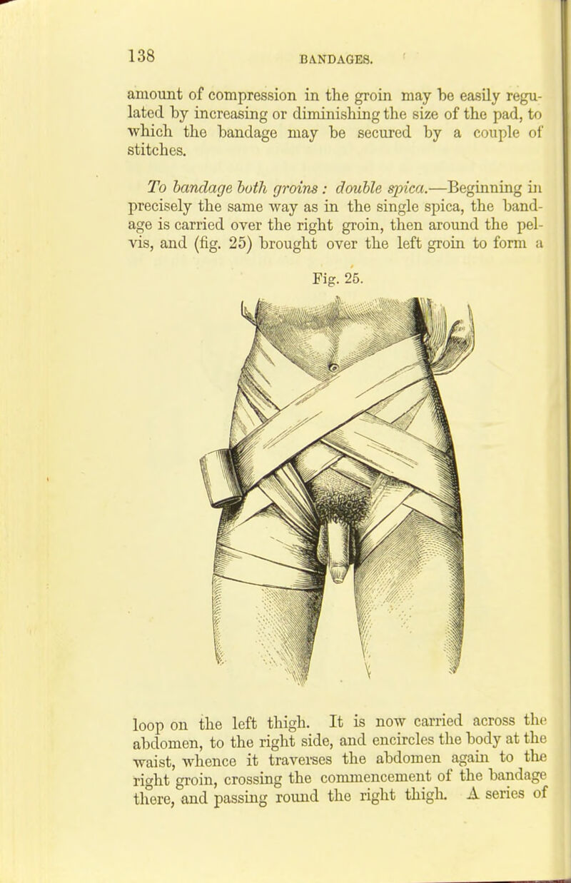 amount of compression in the groin may be easily regu- lated by increasing or diminishing the size of the pad, to which the bandage may be secured by a couple oi' stitches. To bandage both groins : double spica.—Beginning in precisely the same way as in the single spica, the band- age is carried over the right groin, then around the pel- vis, and (fig. 25) brought over the left groin to form a Fig. 25. loop on the left thigh. It is now carried across the abdomen, to the right side, and encircles the body at the waist, whence it traverses the abdomen again to the right groin, crossing the commencement of the bandage there, and passing round the right thigk A series of