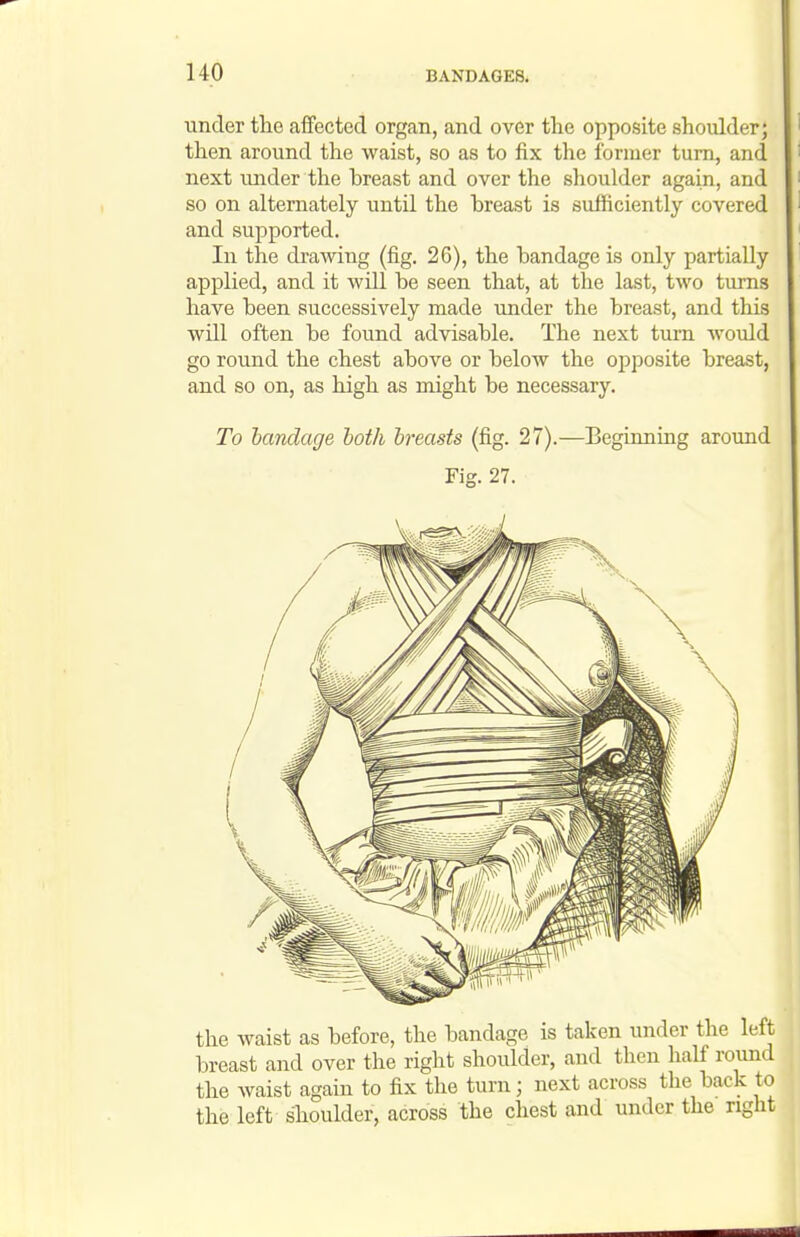 under the affected organ, and over the opposite shoulder; then around the waist, so as to fix the former turn, and next under the breast and over the slioulder again, and so on alternately until the breast is sufficiently covered and supported. In the drawing (fig. 26), the bandage is only partially applied, and it will be seen that, at the last, two turns have been successively made under the breast, and this will often be found advisable. The next turn would go round the chest above or below the opposite breast, and so on, as high as might be necessary. To bandage both breasts (fig. 27).—Beginning around Fig. 27. the waist as before, the bandage is taken under the left breast and over the right shoulder, and then half round the waist again to fix the turn; next across the back to the left shoulder, across the chest and under the right