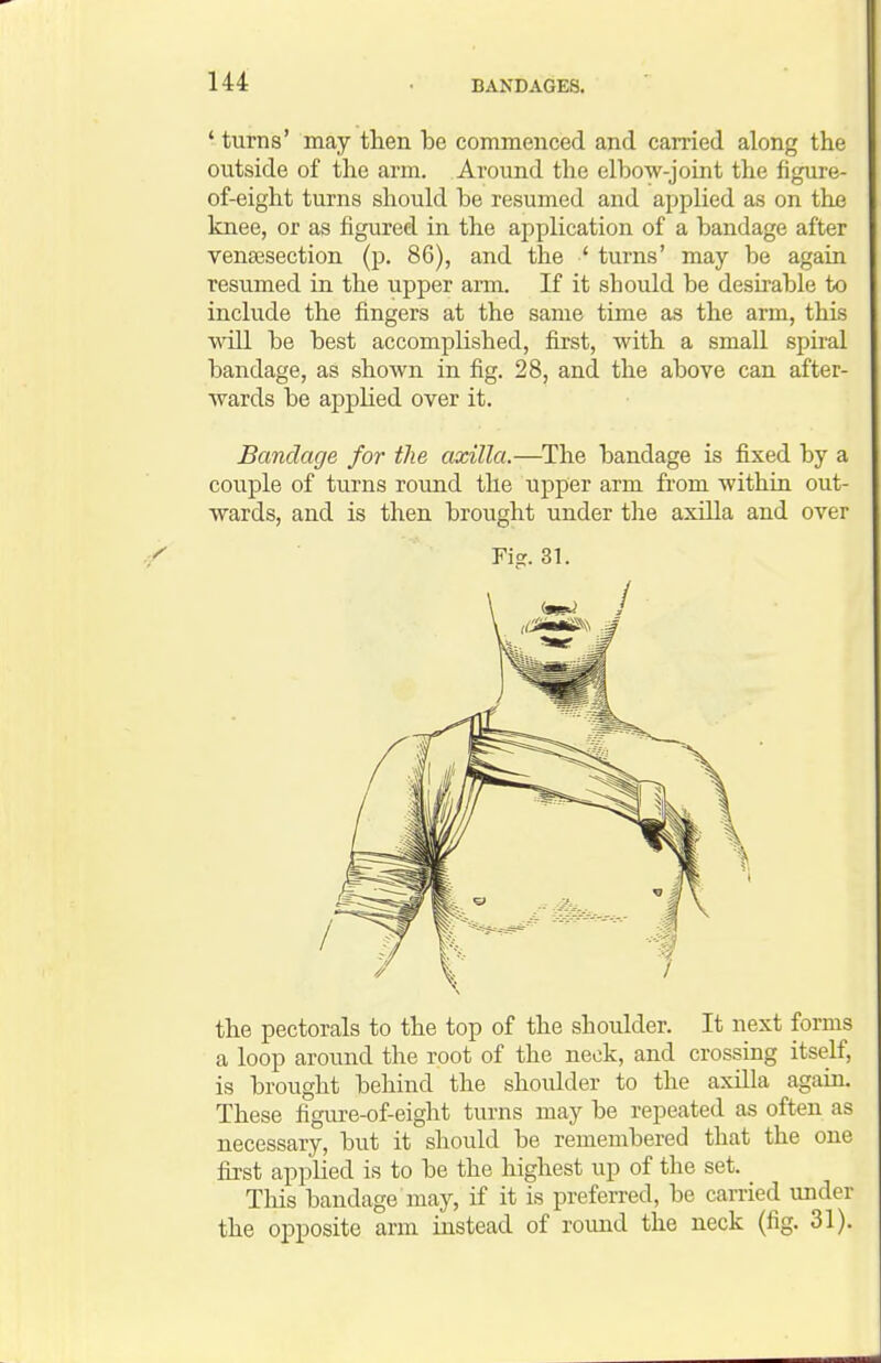 ' turns' may then be commenced and carried along the outside of the arm. Around the elbow-joint the figure- of-eight turns should be resumed and applied as on the knee, or as figured in the application of a bandage after vena3section (p. 86), and the ' turns' may be again resumed in the upper arm. If it should be desirable to include the fingers at the same time as the arm, this \\all be best accomplished, first, with a small spiral bandage, as shown in fig. 28, and the above can after- wards be applied over it. Bandage for the axilla.—The bandage is fixed by a couple of turns round the upper arm from within out- wards, and is then brought under the axilla and over Fig. 31. the pectorals to the top of the shoulder. It next forms a loop around the root of the neck, and crossing itself, is brought behind the shoulder to the axilla again. These figure-of-eight turns may be repeated as often as necessary, but it should be remembered that the one first applied is to be the highest up of the set. Tliis bandage may, if it is preferred, be carried under the opposite arm instead of roimd the neck (fig. 31).