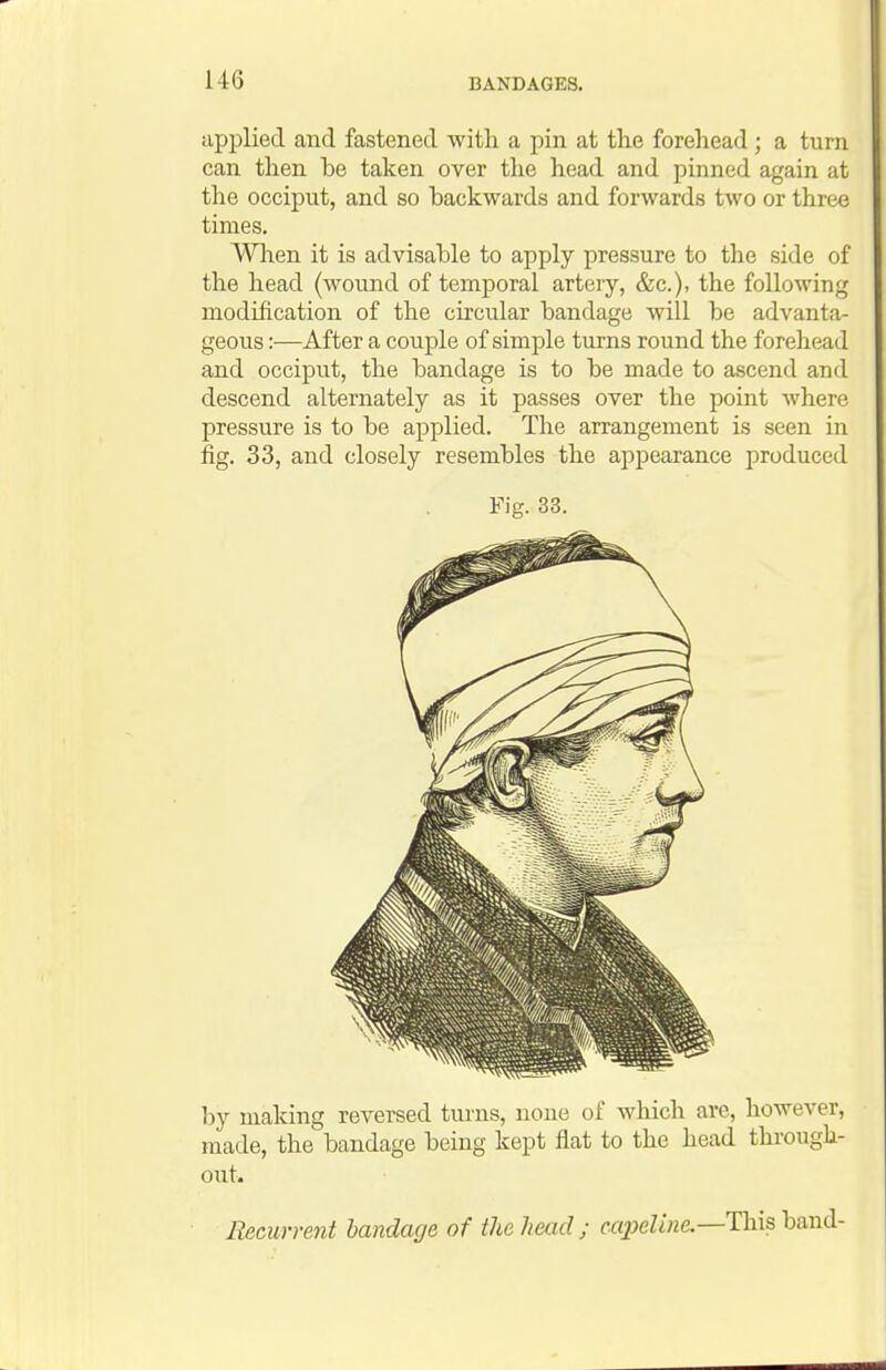 U6 api)lied and fastened with a pin at the forehead; a turn can then be taken over the head and pinned again at the occiput, and so backwards and forwards two or three times. Wlien it is advisable to apply pressure to the side of the head (wound of temporal artery, &c.), the following modification of the circular bandage will be advanta- geous :—After a couple of simple turns round the forehead and occiput, the bandage is to be made to ascend and descend alternately as it passes over the point where pressure is to be applied. The arrangement is seen in fig. 33, and closely resembles the appearance produced Fig. 33. hj making reversed tui'ns, none of which are, however, made, the bandage being kept flat to the head through- out. Recurrent bandage of the head; ccqjeline.—This hand-
