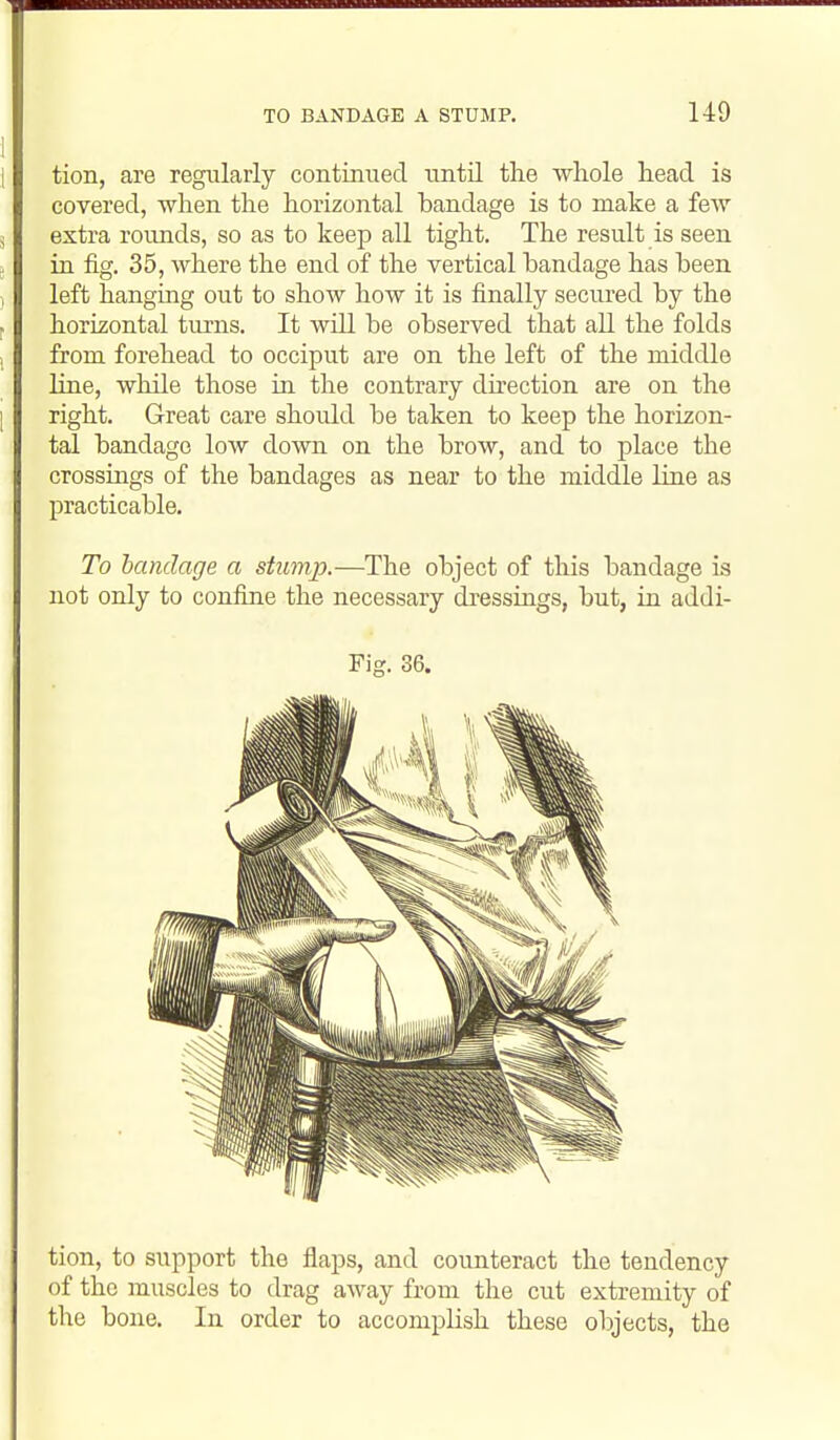 tion, are regularly continued until the vvliole head is covered, when the horizontal bandage is to make a few extra rounds, so as to keep all tight. The result is seen in fig. 35, where the end of the vertical bandage has been left hanging out to show how it is finally secured by the horizontal turns. It will be observed that all the folds from forehead to occiput are on the left of the middle line, while those in the contrary du-ection are on the right. Great care should be taken to keep the horizon- tal bandage low down on the brow, and to place the crossings of the bandages as near to the middle line as practicable. To bandage a stump.—The object of this bandage is not only to confijie the necessary dressings, but, in addi- Fig. 36. tion, to support the flaps, and counteract the tendency of the muscles to drag away from the cut extremity of the bone. In order to accomplish these objects, the