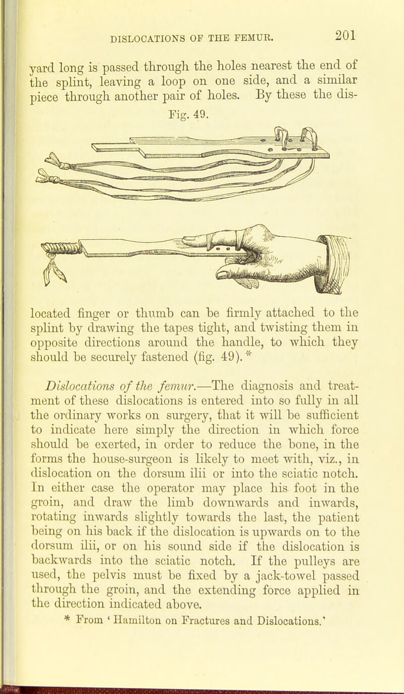 yard long is passed tkrougli the holes nearest the end of the spHnt, leaving a loop on one side, and a sinular piece through another pair of holes. By these the dis- Fig. 49. located finger or thumh can be firmly attached to the splint by drawing the tapes tight, and twisting them in opposite directions around the handle, to which they should be securely fastened (fig. 49).* Dislocations of the femur.—The diagnosis and treat- ment of these dislocations is entered into so fidly in all the OT'dinary works on surgery, that it will be sufficient to indicate here simply the direction in which force shoidd be exerted, in order to reduce the bone, in the forms the house-surgeon is likely to meet with, viz., in dislocation on the dorsum ilii or into the sciatic notch. In either case the operator may place his foot in the groin, and draw the limb downwards and inwards, rotating inwards slightly towards the last, the patient being on his back if the dislocation is upwards on to the dorsum ilii, or on his sound side if the dislocation is backwards into the sciatic notch. If the pulleys are used, the pelvis must be fixed by a jack-towel passed through the groin, and the extending force applied in the direction indicated above.