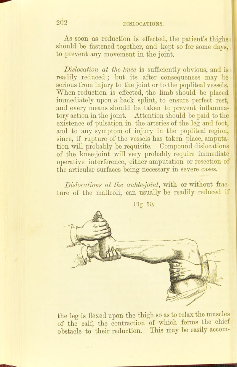 As soon as reduction is effected, the patient's thighs should be fastened together, and kept so for some days, to prevent any movement in the joint. Dislocation at the knee is sufficiently obvious, and is readily reduced; but its after consequences may be serious from injury to the joint or to the popliteal vessels. When reduction is effected, the limb should be placed immediately upon a back splint, to ensure perfect rest, and every means should be taken to prevent inflamma- tory action in the joint. Attention shoidd be paid to the existence of pulsation in the arteries of the leg and foot, and to any symptom of injury in the popliteal region, since, if rupture of the vessels has taken place, amputa- tion will probably be requisite. Compound dislocations of the knee-joint will very probably require immediate ojDerative interference, either amputation or resection of the articular sui'faces being necessary in severe cases. Dislocations at the ankle-joint, with or without frac- tui-e of the malleoli, can usually be readily reduced if Fig 50. the leg is flexed upon the tliigh so as to relax the muscles of the calf, the contraction of which forms the chief obstacle to their reduction. Tliis may be easily accom-