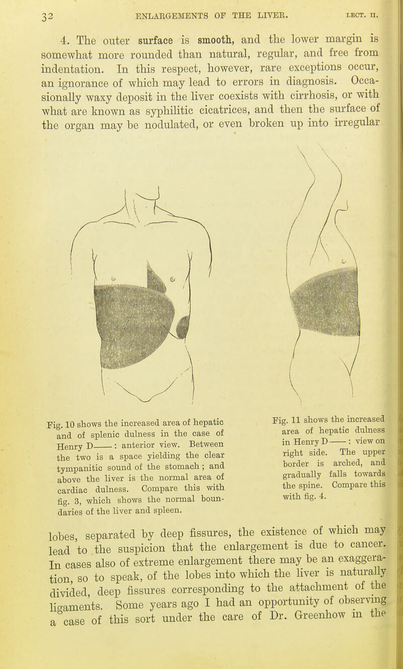 4. The outer surface is smooth, and the lower margin is somewhat more rounded than natural, regular, and free from indentation. In this respect, however, rare exceptions occur, an ignorance of which may lead to errors in diagnosis. Occa- sionally waxy deposit in the liver coexists with cirrhosis, or with what are known as syphilitic cicatrices, and then the surface of the organ may be nodulated, or even broken up into irregular Fig. 11 shows the increased area of hepatic dulness in Henry D : view on right side. The upper border is arched, and gradually falls towards the spine. Compare this with fig. 4. Fig. 10 shows the increased area of hepatic and of splenic dulness in the case of Henry D : anterior view. Between the two is a space yielding the clear tympanitic sound of the stomach; and above the liver is the normal area of cardiac dulness. Compare this with fig. 3, which shows the normal boun- daries of the liver and spleen. lobes, separated by deep fissures, the existence of which may lead 'to the suspicion that the enlargement is due to cancer. In cases also of extreme enlargement there may be an exaggera- tion, so to speak, of the lobes into which the liver is naturally divided, deep fissures corresponding to the attachment of the lio-aments Some years ago I had an opportunity of observing a°case of this sort under the care of Dr. Greenhow in the