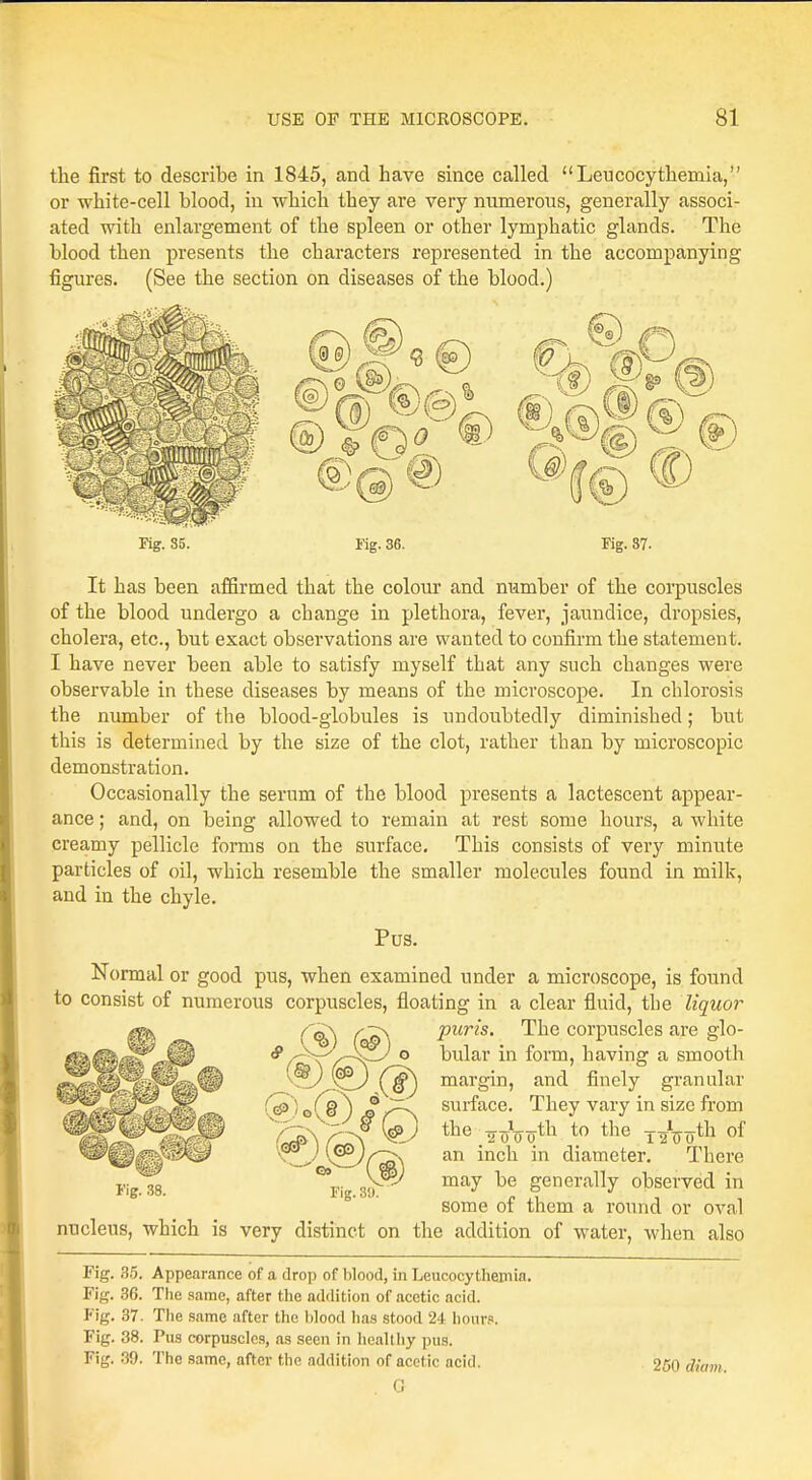 the first to describe in 1845, and have since called Leucocythemia, or white-cell blood, in which they are very numerous, generally associ- ated with enlargement of the spleen or other lymphatic glands. The blood then presents the characters represented in the accompanying figures. (See the section on diseases of the blood.) 0 V&/*r ^0 Fig. 35. Kg. 36. Kg. 37. It has been affirmed that the colour and number of the corpuscles of the blood undergo a change in plethora, fever, jaundice, dropsies, cholera, etc., but exact observations are wanted to confirm the statement. I have never been able to satisfy myself that any such changes were observable in these diseases by means of the microscope. In chlorosis the number of the blood-globules is undoubtedly diminished; but this is determined by the size of the clot, rather than by microscopic demonstration. Occasionally the serum of the blood presents a lactescent appear- ance ; and, on being allowed to remain at rest some hours, a white creamy pellicle forms on the surface. This consists of very minute particles of oil, which resemble the smaller molecules found in milk, and in the chyle. Pus. Normal or good pus, when examined under a microscope, is found to consist of numerous corpuscles, floating in a clear fluid, the liquor puris. The corpuscles are glo- bular in form, having a smooth margin, and finely granular surface. They vary in size from the . <n> oth the TaW11 of an inch in diameter. There may be generally observed in some of them a round or oval nucleus, which is very distinct on the addition of water, when also Fig. 38. ©9 Fig. 39. Fig. 35. Appearance of a drop of blood, in Leucocythemia. Fig. 36. The same, after the addition of acetic acid. Fig. 37. The same after the blood has stood 24 hour?. Fig. 38. Pus corpuscles, as seen in healthy pus. Fig. 39. The same, after the addition of acetic acid. G