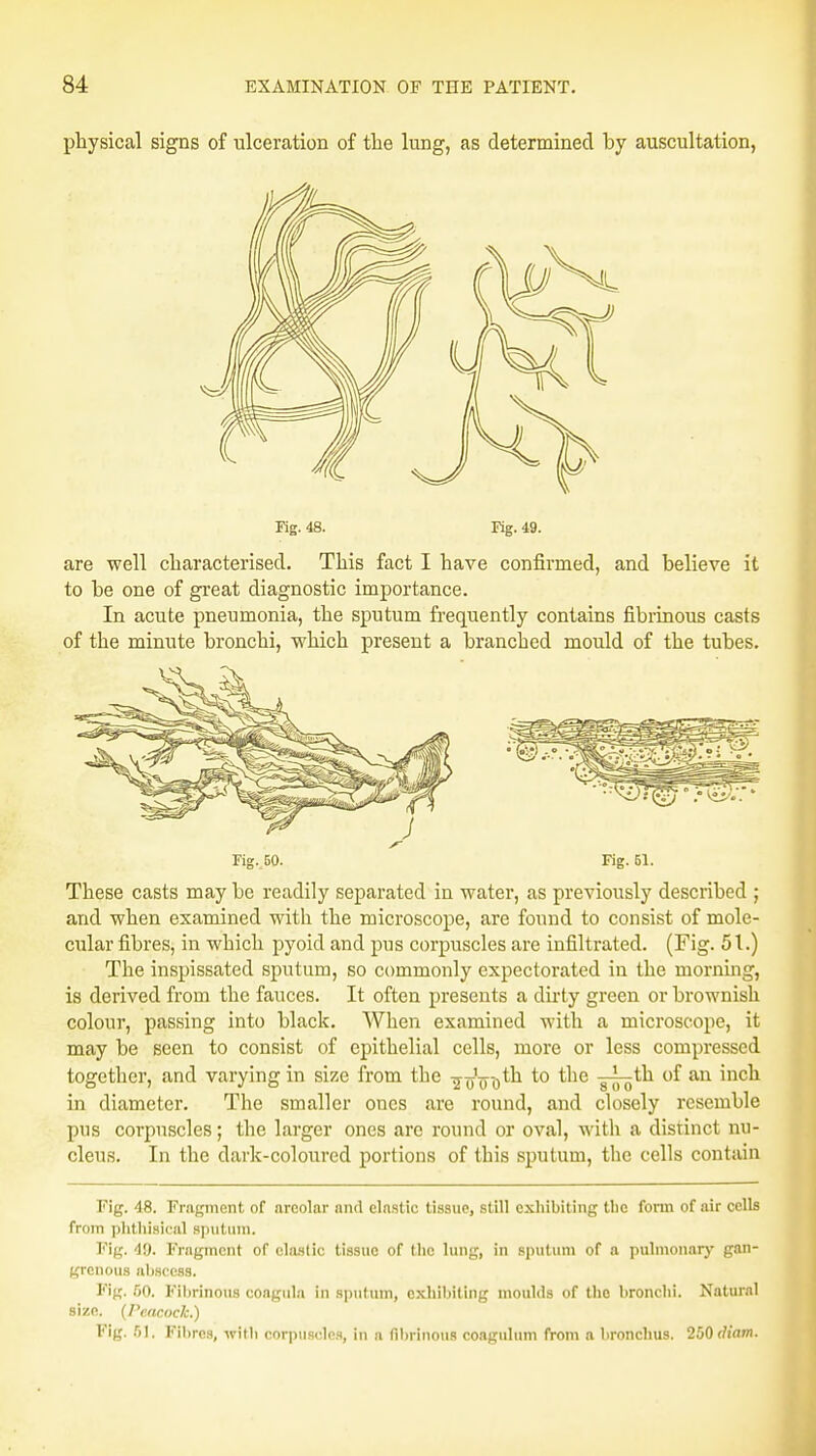 physical signs of ulceration of the lung, as determined by auscultation, Fig. 48. Eg. 49. are well characterised. This fact I have confirmed, and believe it to be one of great diagnostic importance. In acute pneumonia, the sputum frequently contains fibrinous casts of the minute bronchi, which present a branched mould of the tubes. Fig. 50. Fig. 51. These casts may be readily separated in water, as previously described ; and when examined with the microscope, are found to consist of mole- cular fibres, in which pyoid and pus corpuscles are infiltrated. (Fig. 51.) The inspissated sputum, so commonly expectorated in the morning, is derived from the fauces. It often presents a dirty green or brownish colour, passing into black. When examined with a microscope, it may be seen to consist of epithelial cells, more or less compressed together, and varying in size from the ^-g^th to the j^th of an inch in diameter. The smaller ones are round, and closely resemble pus corpuscles; the larger ones arc round or oval, with a distinct nu- cleus. In the dark-coloured portions of this sputum, the cells contain Fig. 48. Fragment of nrcolar nwl elastic tissue, still exhibiting the form of nir cells from phthisical spul um. Vifr. 49. Fragment of clastic tissue of the lung, in sputum of a pulmonary gan- grenous abscess. Fig. 60. Fibrinous coagula in sputum, exhibiting moulds of the bronchi. Natural size. (Peacock.) Fig. 61, Fibres, with corpuscles, in a fibrinous coagulum from a bronchus. 250<liam.