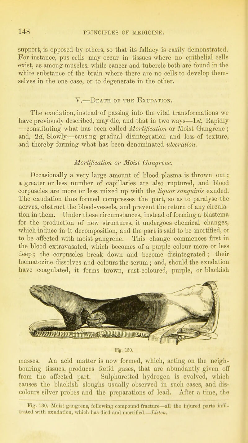 support, is opposed by others, so that its fallacy is easily demonstrated. For instance, pus cells may occur in tissues where no epithelial cells exist, as among muscles, while cancer and tubercle both are found in the white substance of the brain where there are no cells to develop them- selves in the one case, or to degenerate in the other. V.—Death of the Exudation. The exudation, instead of passing into the vital transformations we have previously described, may die, and that in two ways—1st, Eapidly —constituting what has been called Mortification or Moist Gangrene ; and, 2d, Slowly—causing gradual disintegration and loss of texture, and thereby forming what has been denominated ulceration. Mortification or Moist Gangrene. Occasionally a very large amount of blood plasma is thrown out; a greater or less number of capillaries are also ruptured, and blood corpuscles are more or less mixed up with the liquor sanguinis exuded. The exudation thus formed compresses the part, so as to paralyse-the nerves, obstruct the blood-vessels, and prevent the return of any circula- tion in them. Under these circumstances, instead of forming a blastema for the production of new structures, it undergoes chemical changes, which induce in it decomposition, and the part is said to be mortified, or to be affected with moist gangrene. This change commences first in the blood extravasated, which becomes of a purple colour more or less deep; the corpuscles break down and become disintegrated; their hajmatozine dissolves and colours the serum ; and, should the exudation have coagulated, it forms brown, rust-coloured, purple, or blackish Fig. 130. masses. An acid matter is now formed, which, acting on the neigh- bouring tissues, produces foetid gases, that are abundantly given off from the affected part. Sulphuretted hydrogen is evolved, which causes the blackish sloughs usually observed in such cases, and dis- colours silver probes and the preparations of lead. After a time, the Fig. 130. Moist gangrene, following compound rrncttire—nil llic injured parts infil- trated with exudation, which has died and mortified.—Lhttm.