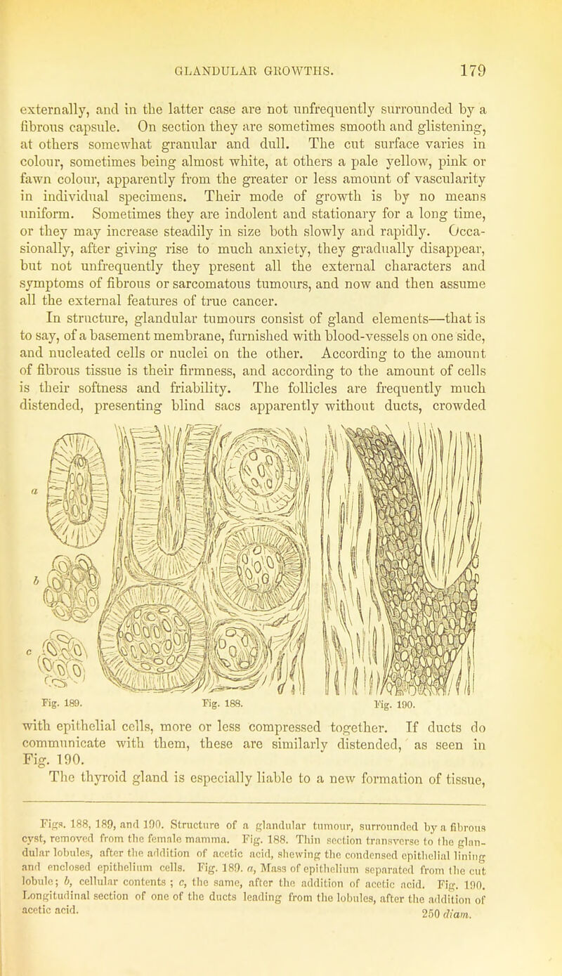 externally, and in the latter case are not unfrequently surrounded by a fibrous capside. On section they are sometimes smooth and glistening, at others somewhat granular and dull. The cut surface varies in colour, sometimes being almost white, at others a pale yellow, pink or fawn colour, apparently from the greater or less amount of vascularity in individual specimens. Their mode of growth is by no means uniform. Sometimes they are indolent and stationary for a long time, or they may increase steadily in size both slowly and rapidly. Occa- sionally, after giving rise to much anxiety, they gradually disappear, but not unfrequently they present all the external characters and symptoms of fibrous or sarcomatous tumours, and now and then assume all the external features of true cancer. In structure, glandular tumours consist of gland elements—that is to say, of a basement membrane, furnished with blood-vessels on one side, and nucleated cells or nuclei on the other. According to the amount of fibrous tissue is their firmness, and according to the amount of cells is their softness and friability. The follicles are frequently much distended, presenting blind sacs apparently without ducts, crowded - —~— r ' ■ '— V- V <l U 1 1 11 I) If 1 iST'J'CA. Tig- 189. Fig. 188. Kg. 190. with epithelial cells, more or less compressed together. If ducts do communicate with them, these are similarly distended, as seen in Fig. 190. The thyroid gland is especially liable to a new formation of tissue, Fig*. 188, 189, and 190. Structure of .a glandular tumour, surrounded by a fibrous cyst, removed from the female mamma. Fig. 188. Thin section transverse to the glan- dular lobules, after the addition of acetic acid, shewing the condensed epithelial lining and enclosed epithelium cells. Fig. 189. a, Mass of epithelium separated from the cut lobule; b, cellular contents ; e, the same, after the addition of acetic acid. Fig. 190. Longitudinal section of one of the ducts leading from the lobules, after the addition of acetic acid. 250 (h-am