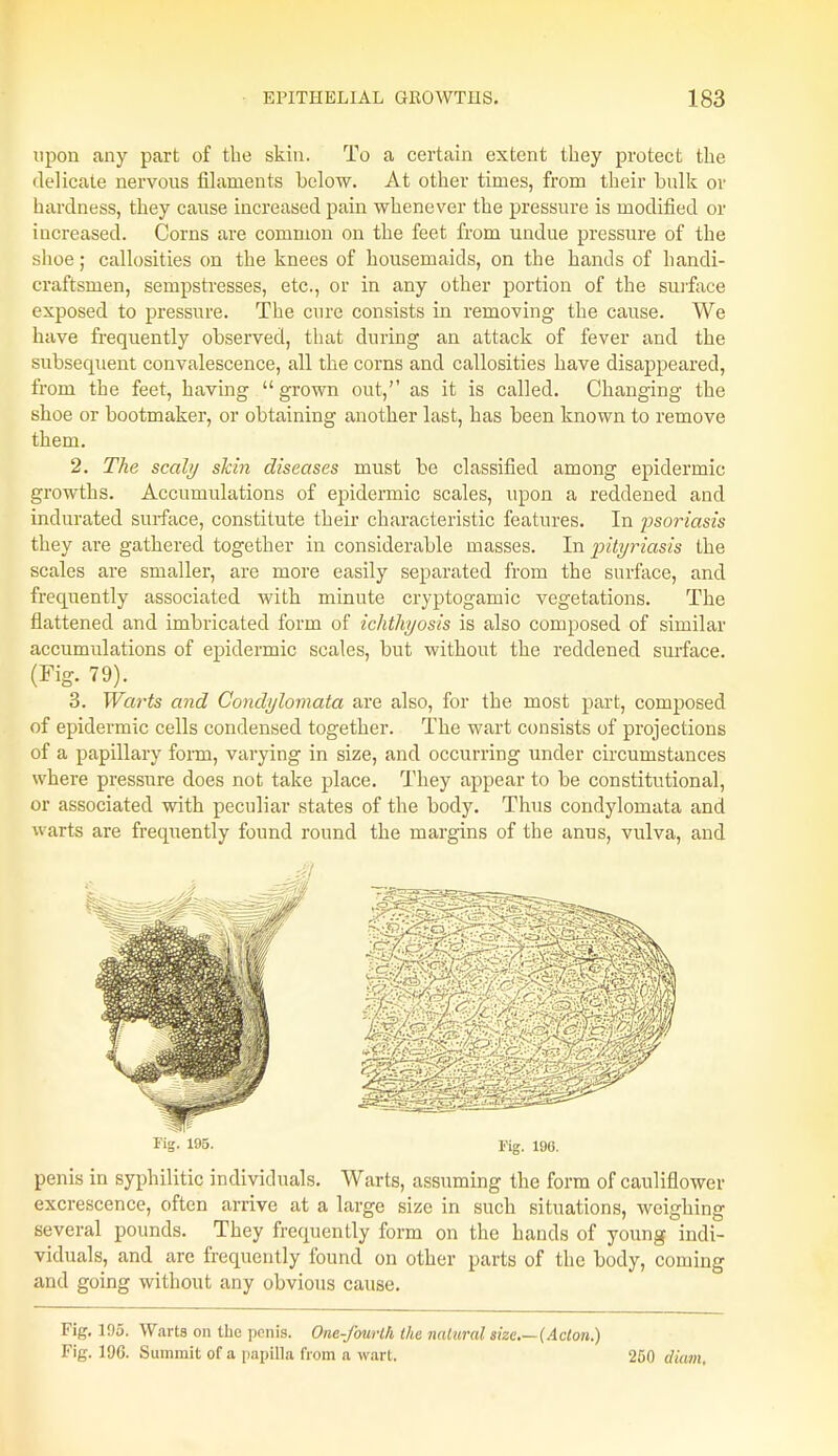 upon any part of the skin. To a certain extent they protect the ilelicate nervous filaments below. At other times, from their bulk or hardness, they cause increased pain whenever the pressure is modified or increased. Corns are common on the feet from undue pressure of the shoe; callosities on the knees of housemaids, on the hands of handi- craftsmen, sempstresses, etc., or in any other portion of the surface exposed to pressure. The cure consists in removing the cause. We have frequently observed, that during an attack of fever and the subsequent convalescence, all the corns and callosities have disappeared, from the feet, having grown out,'' as it is called. Changing the shoe or bootmaker, or obtaining another last, has been known to remove them. 2. The scaly skin diseases must be classified among epidermic growths. Accumulations of epidermic scales, upon a reddened and indurated surface, constitute their characteristic features. In psoriasis they are gathered together in considerable masses. In pityriasis the scales are smaller, are more easily separated from the surface, and frequently associated with minute cryptogamic vegetations. The flattened and imbricated form of ichthyosis is also composed of similar accumulations of epidermic scales, but without the reddened surface. (Fig. 79). 3. Warts and Condylomata are also, for the most part, composed of epidermic cells condensed together. The wart consists of projections of a papillary form, varying in size, and occurring under circumstances where pressure does not take place. They appear to be constitutional, or associated with peculiar states of the body. Thus condylomata and warts are frequently found round the margins of the anus, vulva, and Fig. 195. Fig. 196. penis in syphilitic individuals. Warts, assuming the form of cauliflower excrescence, often arrive at a large size in such situations, weighing several pounds. They frequently form on the hands of young indi- viduals, and are frequently found on other parts of the body, coming and going without any obvious cause. Fig. 105. Warts on the penis. One-fourlh the natural size—(Acton.) Fig. 19G. Summit of a papilla from a wart. 250 diam.