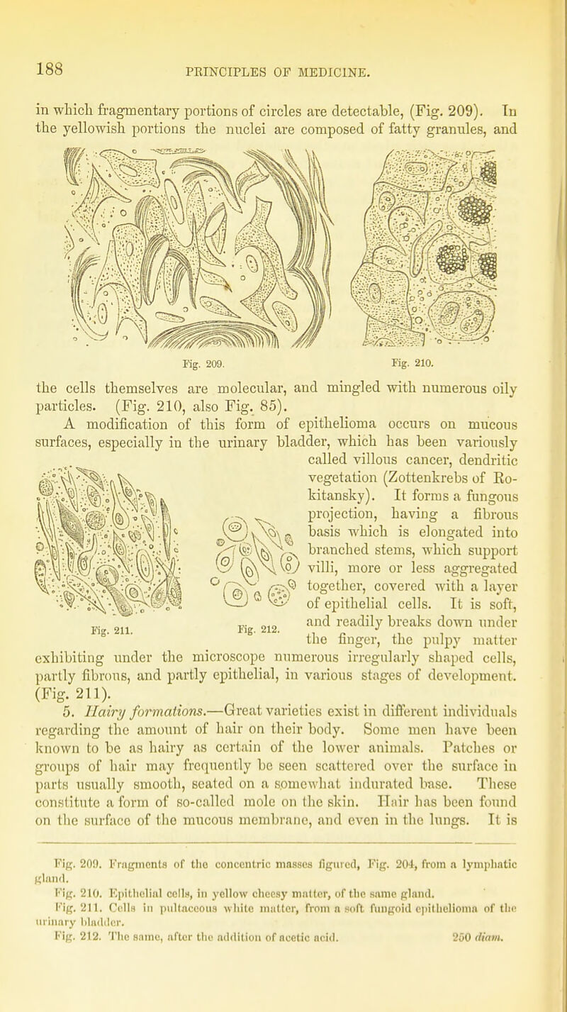 in which fragmentary portions of circles are detectable, (Fig. 209). In the yellowish portions the nuclei are composed of fatty granules, and Kg. 209. Kg. 210. the cells themselves are molecular, and mingled with numerous oily particles. (Fig. 210, also Fig. 85). A modification of this form of epithelioma occurs on mucous surfaces, especially in the urinary bladder, which has been variously called villous cancer, dendritic vegetation (Zottenkrebs of Eo- kitansky). It forms a fungous projection, having a fibrous basis which is elongated into branched stems, which support tijAN^oy villi, more or less aggregated 'fpv . t°getuer> covered with a layer Cli 0 ^} of epithelial cells. It is soft, and readily breaks down under the finger, the pulpy matter exhibiting under the microscope numerous irregularly shaped cells, partly fibrous, and partly epithelial, in various stages of development. (Fig. 211). 5. Hairy formations.—Great varieties exist in different individuals regarding the amount of hair on their body. Some men have been known to be as hairy as certain of the lower animals. Patches or groups of hair may frequently be seen scattered over the surface in parts usually smooth, seated on a somewhat indurated base. These constitute a form of so-called mole on (he skin. Hnir has been found on the surface of the mucous membrane, and even in the lungs. It is Kg. 212. Eig. 20!). Fragments of the concentric masses figured, Fig. 201, from a lymphatic gland. Pig. 210. Epithelial cells, in yellow cheesy matter, of the same gland. Pig, 211, Cells in pultaceous white matter, from n soft fungoid epithelioma of the Urinary Madder. Pig. 212. The same, after the addition of acetic ncid. 960 (Sam.