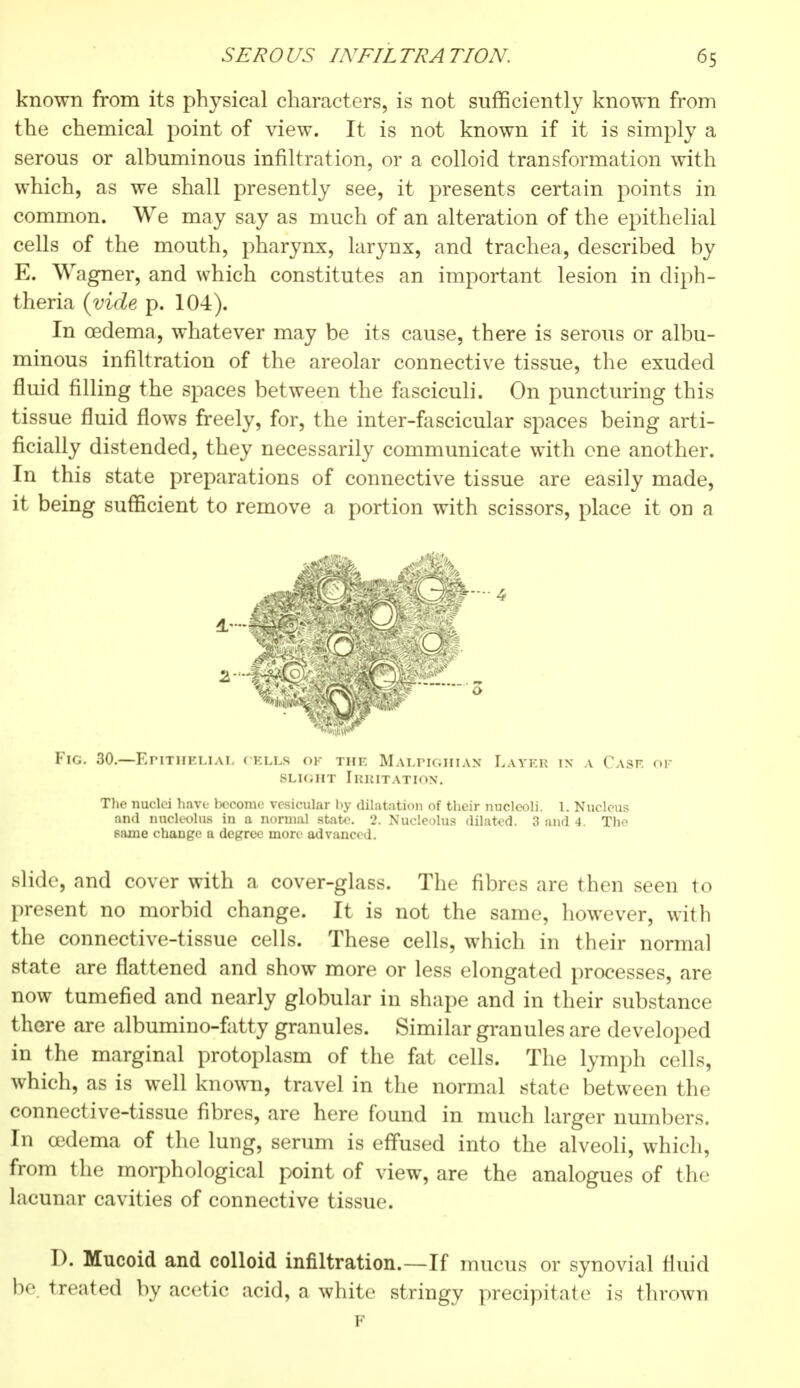 known from its physical characters, is not sufficiently known from the chemical point of view. It is not known if it is simply a serous or albuminous infiltration, or a colloid transformation with which, as we shall presently see, it presents certain points in common. We may say as much of an alteration of the epithelial cells of the mouth, pharynx, larynx, and trachea, described by E. Wagner, and which constitutes an important lesion in diph- theria (vide p. 104). In oedema, whatever may be its cause, there is serous or albu- minous infiltration of the areolar connective tissue, the exuded fluid rilling the spaces between the fasciculi. On puncturing this tissue fluid flows freely, for, the inter-fascicular spaces being arti- ficially distended, they necessarily communicate with one another. In this state preparations of connective tissue are easily made, it being sufficient to remove a portion with scissors, place it on a Fig. 30.—Epithelial cells ok the Malpighian Later in a Case of slight Irritation. The nuclei have become vesicular by dilatation of their nucleoli. 1. Nucleus and nucleolus in a normal state. 2. Nucleolus dilated. 3 and 4. Tho same change a degree more advanced. slide, and cover with a cover-glass. The fibres are then seen to present no morbid change. It is not the same, however, with the connective-tissue cells. These cells, which in their normal state are flattened and show more or less elongated processes, are now tumefied and nearly globular in shape and in their substance there are albumino-fatty granules. Similar granules are developed in the marginal protoplasm of the fat cells. The lymph cells, which, as is well known, travel in the normal state between the connective-tissue fibres, are here found in much larger numbers. In œdema of the lung, serum is effused into the alveoli, which, from the morphological point of view, are the analogues of the lacunar cavities of connective tissue. D. Mucoid and colloid infiltration.—If mucus or synovial fluid be. treated by acetic acid, a white stringy precipitate is thrown F