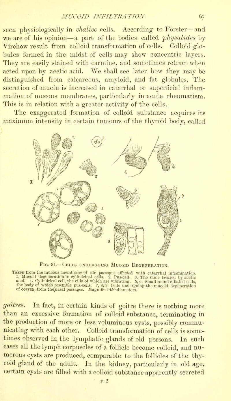 seen physiologically in chalice cells. According to Forster— and we are of his opinion—a part of the bodies called physalides by Virchow result from colloid transformation of cells. Colloid glo- bules formed in the midst of cells may show concentric layers. They are easily stained with carmine, and sometimes retract when acted upon by acetic acid. We shall see later how they may be distinguished from calcareous, amyloid, and fat globules. The secretion of mucin is increased in catarrhal or superficial inflam- mation of mucous membranes, particularly in acute rheumatism. This is in relation with a greater activity of the cells. The exaggerated formation of colloid substance acquires its maximum intensity in certain tumours of the thyroid body, called acid. 4. Cylindrical cell, the cilia of which are vibrating. 5,6. Small round ciliated cells, the body of which resemble pus-cells. 7, 8. 9. Cells undergoing the mucoid degeneration of coryza, from the>asal passages. Magnified 450 diameters. goitres. In fact, in certain kinds of goitre there is nothing more than an excessive formation of colloid substance, terminating in the production of more or less voluminous cysts, possibly commu- nicating with each other. Colloid transformation of cells is some- times observed in the lymphatic glands of old persons. In such cases all the lymph corpuscles of a follicle become colloid, and nu- merous cysts are produced, comparable to the follicles of the thy- roid gland of the adult. In the kidney, particularly in old age, certain cysts are filled with a colloid substance apparently secreted F 2