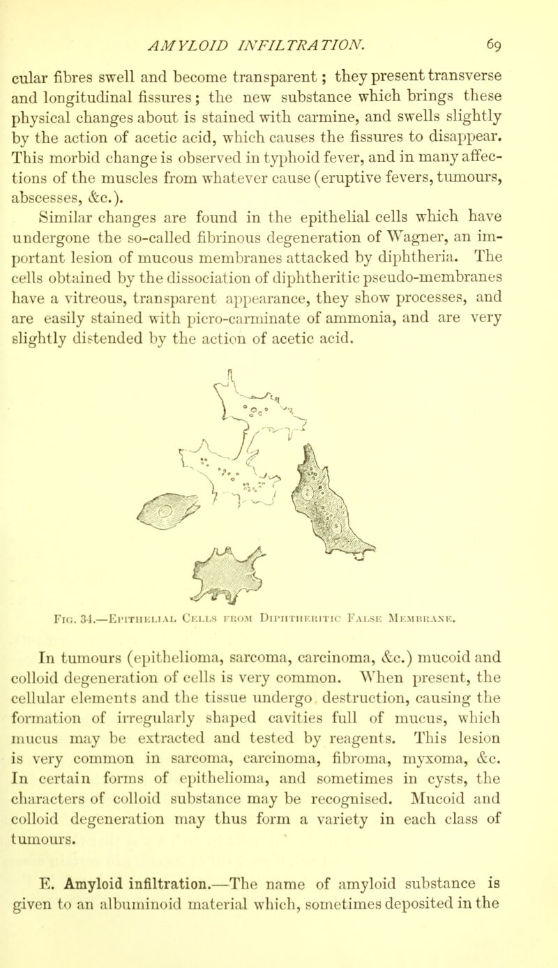 cular fibres swell and become transparent ; they present transverse and longitudinal fissures ; the new substance which brings these physical changes about is stained with carmine, and swells slightly by the action of acetic acid, which causes the fissures to disappear. This morbid change is observed in typhoid fever, and in many affec- tions of the muscles from whatever cause (eruptive fevers, tumours, abscesses, &c). Similar changes are found in the epithelial cells which have undergone the so-called fibrinous degeneration of Wagner, an im- portant lesion of mucous membranes attacked by diphtheria. The cells obtained by the dissociation of diphtheritic pseudo-membranes have a vitreous, transparent appearance, they show processes, and are easily stained with picro-carminate of ammonia, and are very slightly distended by the action of acetic acid. Fig. 34.—Epithelial Cells from Diphtheritic False Membraxr. In tumours (epithelioma, sarcoma, carcinoma, &c.) mucoid and colloid degeneration of cells is very common. When present, the cellular elements and the tissue undergo destruction, causing the formation of irregularly shaped cavities full of mucus, which mucus may be extracted and tested by reagents. This lesion is very common in sarcoma, carcinoma, fibroma, myxoma, &c. In certain forms of epithelioma, and sometimes in cysts, the characters of colloid substance may be recognised. Mucoid and colloid degeneration may thus form a variety in each class of tumours. E. Amyloid infiltration.—The name of amyloid substance is given to an albuminoid material which, sometimes deposited in the