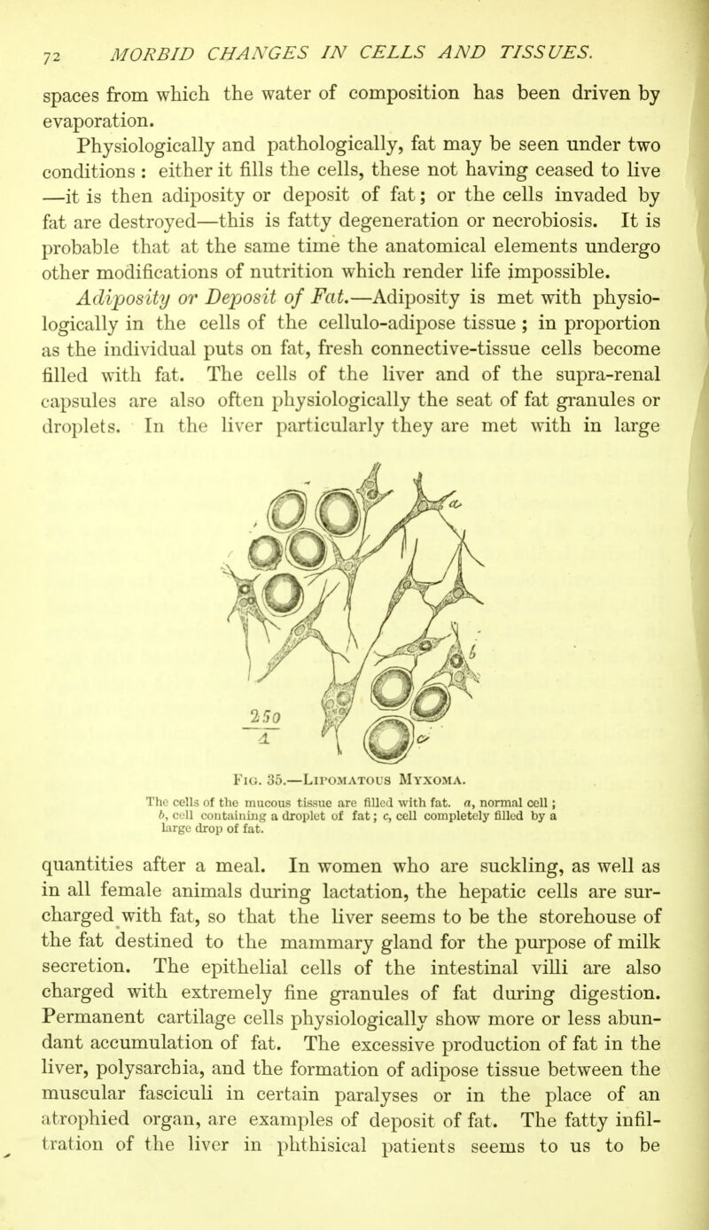 spaces from which the water of composition has been driven by evaporation. Physiologically and pathologically, fat may be seen under two conditions : either it fills the cells, these not having ceased to live —it is then adiposity or deposit of fat ; or the cells invaded by fat are destroyed—this is fatty degeneration or necrobiosis. It is probable that at the same time the anatomical elements undergo other modifications of nutrition which render life impossible. Adiposity or Deposit of Fat.—Adiposity is met with physio- logically in the cells of the cellulo-adipose tissue ; in proportion as the individual puts on fat, fresh connective-tissue cells become filled with fat. The cells of the liver and of the supra-renal capsules are also often physiologically the seat of fat granules or droplets. In the liver particularly they are met with in large Fig. 35.—Lipomatous Myxoma. The cells of the mucous tissue care filled with fat. a, normal cell ; b, cell containing a droplet of fat ; c, cell completely filled by a large drop of fat. quantities after a meal. In women who are suckling, as well as in all female animals during lactation, the hepatic cells are sur- charged with fat, so that the liver seems to be the storehouse of the fat destined to the mammary gland for the purpose of milk secretion. The epithelial cells of the intestinal villi are also charged with extremely fine granules of fat during digestion. Permanent cartilage cells physiologically show more or less abun- dant accumulation of fat. The excessive production of fat in the liver, polysarchia, and the formation of adipose tissue between the muscular fasciculi in certain paralyses or in the place of an atrophied organ, are examples of deposit of fat. The fatty infil- tration of the liver in phthisical patients seems to us to be