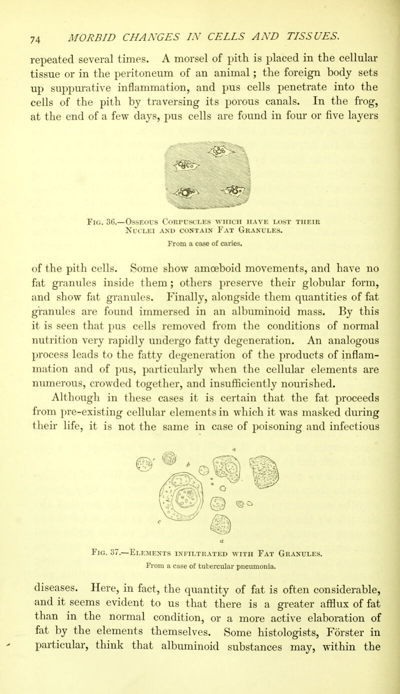 repeated several times. A morsel of pith is placed in the cellular tissue or in the peritoneum of an animal ; the foreign body sets up suppurative inflammation, and pus cells penetrate into the cells of the pith by traversing its porous canals. In the frog, at the end of a few days, pus cells are found in four or five layers Fig. 36.—Osseous Corpuscles which have lost their Nuclei and contain Y\t Granules. From a case of caries. of the pith cells. Some show amoeboid movements, and have no fat granules inside them ; others preserve their globular form, and show fat granules. Finally, alongside them quantities of fat granules are found immersed in an albuminoid mass. By this it is seen that pus cells removed from the conditions of normal nutrition very rapidly undergo fatty degeneration. An analogous process leads to the fatty degeneration of the products of inflam- mation and of pus, particularly when the cellular elements are numerous, crowded together, and insufficiently nourished. Although in these cases it is certain that the fat proceeds from pre-existing cellular elements in which it was masked during their life, it is not the same in case of poisoning and infectious « Fig. 37.—Elements infiltrated with Fat Granules. From a case of tubercular pneumonia. diseases. Here, in fact, the quantity of fat is often considerable, and it seems evident to us that there is a greater afflux of fat than in the normal condition, or a more active elaboration of fat by the elements themselves. Some histologists, Forster in particular, think that albuminoid substances may, within the