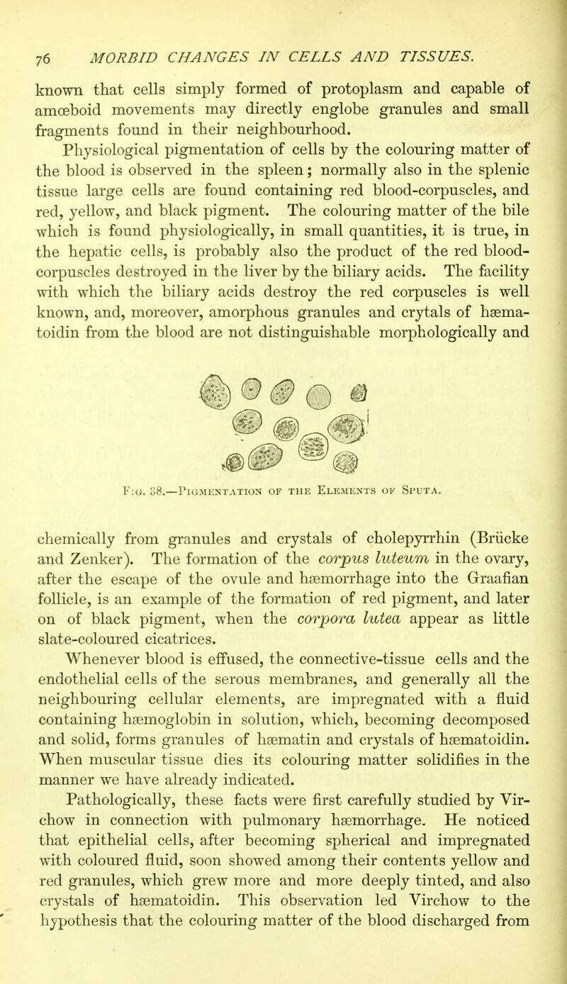 known that cells simply formed of protoplasm and capable of amoeboid movements may directly englobe granules and small fragments found in their neighbourhood. Physiological pigmentation of cells by the colouring matter of the blood is observed in the spleen ; normally also in the splenic tissue large cells are found containing red blood-corpuscles, and red, yellow, and black pigment. The colouring matter of the bile which is found physiologically, in small quantities, it is true, in the hepatic cells, is probably also the product of the red blood- corpuscles destroyed in the liver by the biliary acids. The facility with which the biliary acids destroy the red corpuscles is well known, and, moreover, amorphous granules and crytals of haema- toidin from the blood are not distinguishable morphologically and Fig. 38.—Pigmentation of the Elements of Sputa. chemically from granules and crystals of cholepyrrhin (Briicke and Zenker). The formation of the corpus luteum in the ovary, after the escape of the ovule and haemorrhage into the Graafian follicle, is an example of the formation of red pigment, and later on of black pigment, when the corpora lutea appear as little slate-coloured cicatrices. Whenever blood is effused, the connective-tissue cells and the endothelial cells of the serous membranes, and generally all the neighbouring cellular elements, are impregnated with a fluid containing haemoglobin in solution, which, becoming decomposed and solid, forms granules of haematin and crystals of haematoidin. When muscular tissue dies its colouring matter solidifies in the manner we have already indicated. Pathologically, these facts were first carefully studied by Vir- chow in connection with pulmonary haemorrhage. He noticed that epithelial cells, after becoming spherical and impregnated with coloured fluid, soon showed among their contents yellow and red granules, which grew more and more deeply tinted, and also crystals of haematoidin. This observation led Virchow to the hypothesis that the colouring matter of the blood discharged from