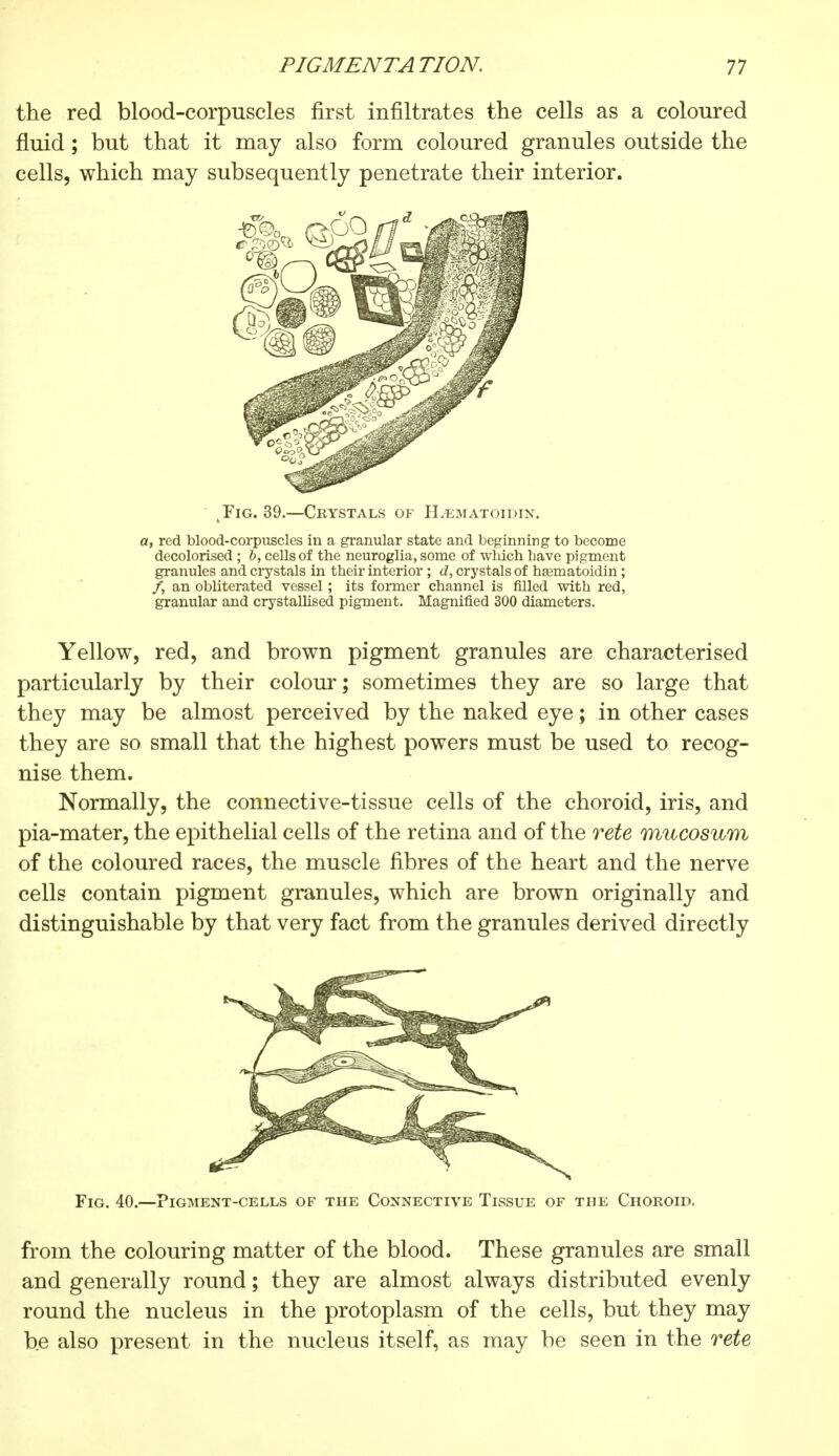 the red blood-corpuscles first infiltrates the cells as a coloured fluid ; but that it may also form coloured granules outside the cells, which may subsequently penetrate their interior. Fig. 39.—Crystals of ELematoidin. a, red blood-corpuscles in a granular state and beginning to become decolorised ; b, cells of the neuroglia, some of winch have pigment granules and crystals in their interior ; d, crystals of hasmatoidin ; /, an obliterated vessel ; its former channel is filled with red, granular and crystallised pigment. Magnified 300 diameters. Yellow, red, and brown pigment granules are characterised particularly by their colour; sometimes they are so large that they may be almost perceived by the naked eye ; in other cases they are so small that the highest powers must be used to recog- nise them. Normally, the connective-tissue cells of the choroid, iris, and pia-mater, the epithelial cells of the retina and of the rete mucosum of the coloured races, the muscle fibres of the heart and the nerve cells contain pigment granules, which are brown originally and distinguishable by that very fact from the granules derived directly Fig. 40.—Pigment-cells of the Connective Tissue of the Choroid. from the colouring matter of the blood. These granules are small and generally round ; they are almost always distributed evenly round the nucleus in the protoplasm of the cells, but they may be also present in the nucleus itself, as may be seen in the rete