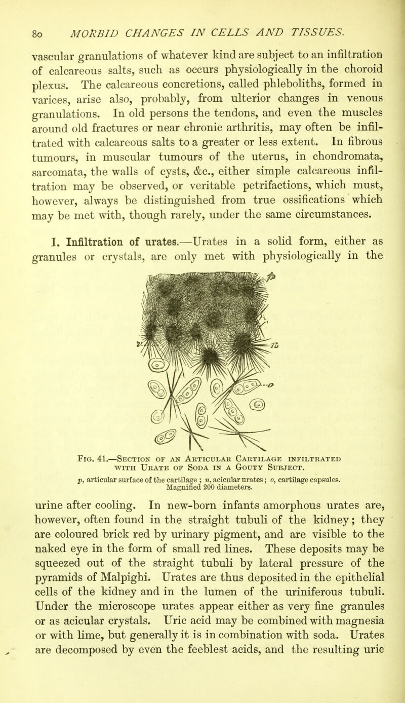 vascular granulations of whatever kind are subject to an infiltration of calcareous salts, such as occurs physiologically in the choroid plexus. The calcareous concretions, called phleboliths, formed in varices, arise also, probably, from ulterior changes in venous granulations. In old persons the tendons, and even the muscles around old fractures or near chronic arthritis, may often be infil- trated with calcareous salts to a greater or less extent. In fibrous tumours, in muscular tumours of the uterus, in chondromata, sarcomata, the walls of cysts, &c, either simple calcareous infil- tration may be observed, or veritable petrifactions, which must, however, always be distinguished from true ossifications which may be met with, though rarely, under the same circumstances. I. Infiltration of urates.—Urates in a solid form, either as granules or crystals, are only met with physiologically in the Fig. 41.—Section of an Articular Cartilage infiltrated with Urate of Soda in a Gouty Subject. p, articular surface of the cartilage ; n, acicular urates ; o, cartilage capsules. Magnified 200 diameters. urine after cooling. In new-born infants amorphous urates are, however, often found in the straight tubuli of the kidney ; they are coloured brick red by urinary pigment, and are visible to the naked eye in the form of small red lines. These deposits may be squeezed out of the straight tubuli by lateral pressure of the pyramids of Malpighi. Urates are thus deposited in the epithelial cells of the kidney and in the lumen of the uriniferous tubuli. Under the microscope urates appear either as very fine granules or as acicular crystals. Uric acid may be combined with magnesia or with lime, but generally it is in combination with soda. Urates are decomposed by even the feeblest acids, and the resulting uric