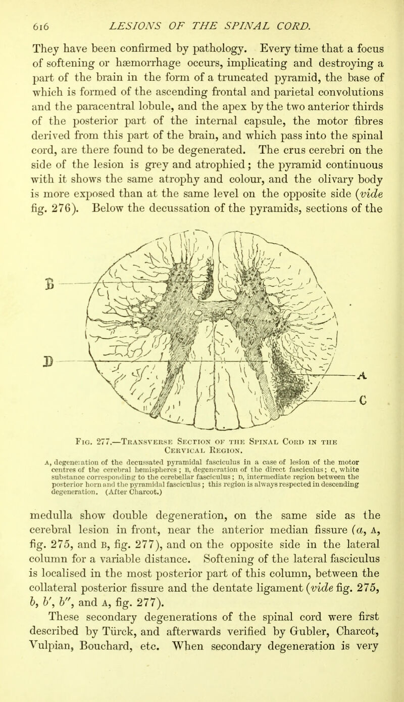 They have been confirmed by pathology. Every time that a focus of softening or haemorrhage occurs, implicating and destroying a part of the brain in the form of a truncated pyramid, the base of which is formed of the ascending frontal and parietal convolutions and the paracentral lobule, and the apex by the two anterior thirds of the posterior part of the internal capsule, the motor fibres derived from this part of the brain, and which pass into the spinal cord, are there found to be degenerated. The crus cerebri on the side of the lesion is grey and atrophied ; the pyramid continuous with it shows the same atrophy and colour, and the olivary body is more exposed than at the same level on the opposite side (vide fig. 276). Below the decussation of the pyramids, sections of the Fig. 277.—Transverse Section of the Spinal Cord in the Cervical Region. A, degeneration of the decussated pyramidal fasciculus in a case of lesion of the motor centres of the cerebral hemispheres; B, degeneration of the direct fasciculus; c, white substance corresponding to the cerebellar fasciculus ; D, intermediate region between the posterior horn and the pyramidal fasciculus ; this region is always respected in descending degeneration. (After Charcot.) medulla show double degeneration, on the same side as the cerebral lesion in front, near the anterior median fissure (a, A, fig. 275, and B, fig. 277), and on the opposite side in the lateral column for a variable distance. Softening of the lateral fasciculus is localised in the most posterior part of this column, between the collateral posterior fissure and the dentate ligament (vide fig. 275, 6, b, and A, fig. 277). These secondary degenerations of the spinal cord were first described by Turck, and afterwards verified by Grubler, Charcot, Vulpian, Bouchard, etc. When secondary degeneration is very