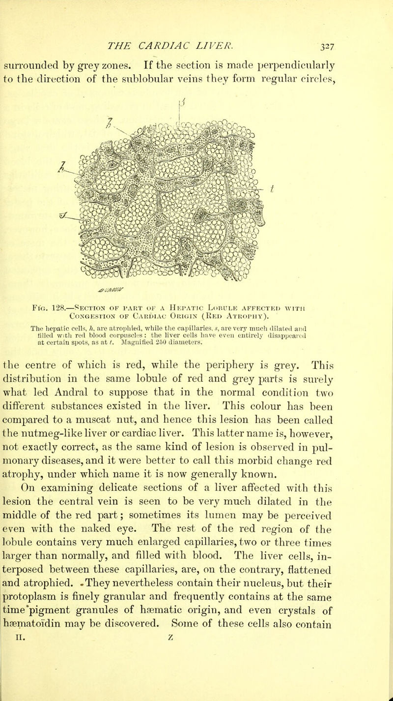 surrounded by grey zones. If the section is made perpendicularl}^ to the direction of the sublobular veins they form regular circles, Fig. 128.—Section of fart of a Hepatic Lobulk xVffected avitii Congestion of Cardiac Origin (Red Atrophy). The hepatic cells, /i, are atrophied, while the capillaries, s, are very much dilated and tilled with red blood corpuscles : the liver cells have even entirely disappeared at certain spots, as at Magnified 250 diameters. the centre of which is red, while the periphery is grey. This distribution in the same lobule of red and grey parts is surely what led Andral to suppose that in the normal condition two different substances existed in the liver. This colour has been compared to a muscat nut, and hence this lesion has been called the nutmeg-like liver or cardiac liver. This latter name is, however, not exactly correct, as the same kind of lesion is observed in pul- monary diseases, and it were better to call this morbid change red atrophy, under which name it is now generally known. On examining delicate sections of a liver affected with this lesion the central vein is seen to be very much dilated in the middle of the red part ; sometimes its lumen may be perceived even with the naked eye. The rest of the red region of the lobule contains very much enlarged capillaries, two or three times larger than normally, and filled with blood. The liver cells, in- terposed between these capillaries, are, on the contrary, flattened and atrophied. -They nevertheless contain their nucleus, but their protoplasm is finely granular and frequently contains at the same time'pigment granules of haematic origin, and even crystals of hsenfiatoïdin may be discovered. Some of these cells also contain II. z