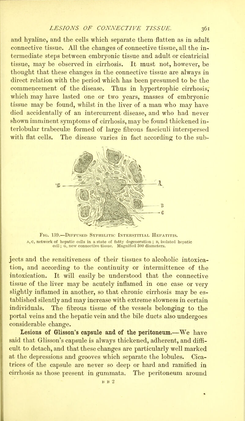 and hyaline, and the cells which separate them flatten as in adult connective tissue. All the changes of connective tissue, all the in- termediate steps between embryonic tissue and adult or cicatricial tissue, may be observed in cirrhosis. It must not, however, be thought that these changes in the connective tissue are always in direct relation with the period which has been presumed to be the commencement of the disease. Thus in hypertrophic cirrhosis, which may have lasted one or two years, masses of embryonic tissue may be found, whilst in the liver of a man who may have died accidentally of an intercurrent disease, and who had never shown imminent symptoms of cirrhosis, may be found thickened in- terlobular trabeculse formed of large fibrous fasciculi interspersed with flat cells. The disease varies in fact according to the sub- Fig. 139.—Diffused Syphilitic Interstitial Hepatitis. A,C, network of hepatic cells in a state of fatty degeneration ; b, isolated hc]iatic cell ; G, new connective tissue. Magnified 300 diameters. jects and the sensitiveness of their tissues to alcoholic intoxica- tion, and according to the continuity or intermittence of the intoxication. It will easily be understood that the connective tissue of the liver may be acutely inflamed in one case or very slightly inflamed in another, so that chronic cirrhosis may be es- tablished silently and may increase with extreme slowness in certain individuals. The fibrous tissue of the vessels belonging to the portal veins and the hepatic vein and the bile ducts also undergoes considerable change. Lesions of Glisson's capsule and of the peritoneum.—We have said that Glisson's capsule is always thickened, adherent, and diffi- cult to detach, and that these changes are particularly well marked at the depressions and grooves which separate the lobules. Cica- trices of the capsule are never so deep or hard and ramified in cirrhosis as those present in gummata. The peritoneum around U B 2