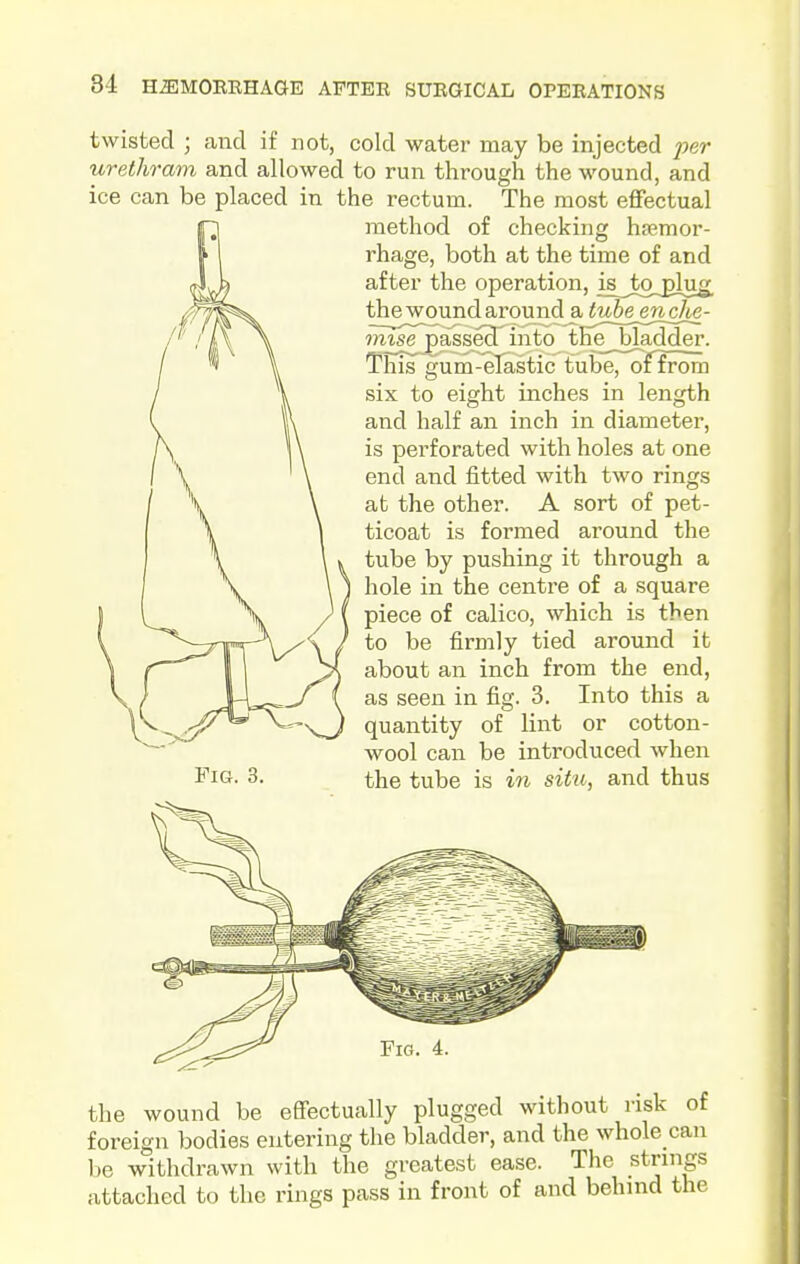 twisted ; and if not, cold water may be injected ^?er urethram and allowed to run through the wound, and ice can be placed in the rectum. The most eflfectual method of checking hasmor- rhage, both at the time of and after the operation, is^to^plu^ thewoundaround a tube enche- m^e[£asse3^ into the^bladder. This gum-eTastic tube, offrom six to eight inches in length and half an inch in diameter, is perforated with holes at one end and fitted with two rings at the other. A sort of pet- ticoat is formed around the tube by pushing it through a hole in the centre of a square piece of calico, which is then to be firmly tied around it about an inch from the end, as seen in fig. 3. Into this a quantity of lint or cotton- wool can be introduced when the tube is in situ, and thus Fig. 3. the wound be eSectually plugged without risk of foreign bodies entering the bladder, and the whole can be withdrawn with the greatest ease. The .strings attached to the rings pass in front of and behind the