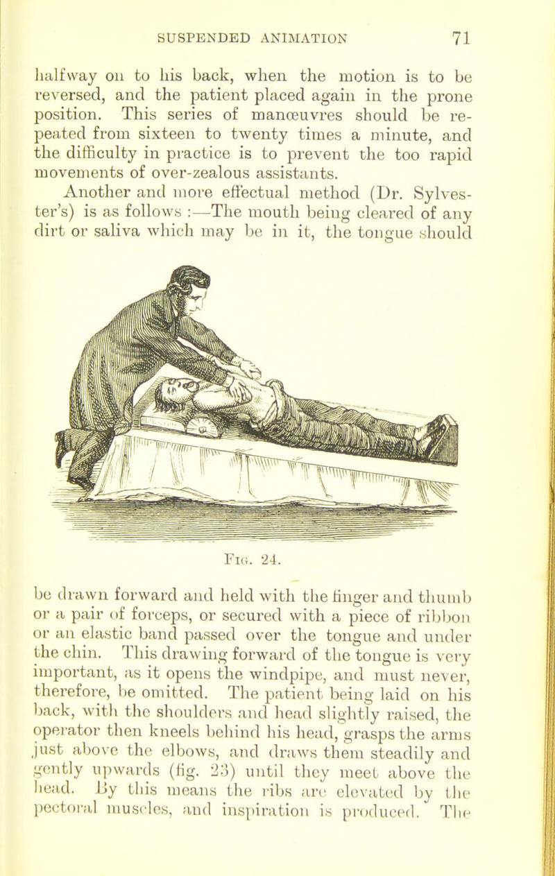 halfway ou to his back, when the motion is to be reversed, and the patient placed again in the prone position. This series of manoeuvres should be re- peated from sixteen to twenty times a minute, and the difficulty in practice is to prevent the too rapid movements of over-zealous assistants. Another and more effectual method (Dr. Sylves- ter's) is as follows :—The mouth being cleared of any dirt or saliva which may be in it, the tongue should Fig. 24. be drawn forward and held with the hnger and tluuub or a pair of forceps, or secured with a piece of ribbon or an elastic band passed over the tongue and under the chin. This drawing forward of the tongue is very important, as it opens the windpipe, and must never, therefore, be omitted. The patient being laid on his back, with the shoulders and head slightly raised, the operator then kneels behind liis head, grasps the arms just above the elbows, and draws them steadily and gently upwards (fig. 2:5) until they meet, above the head. i!y this means the ribs arc elevated by the pectoral muscles, and inspiration is produced. The