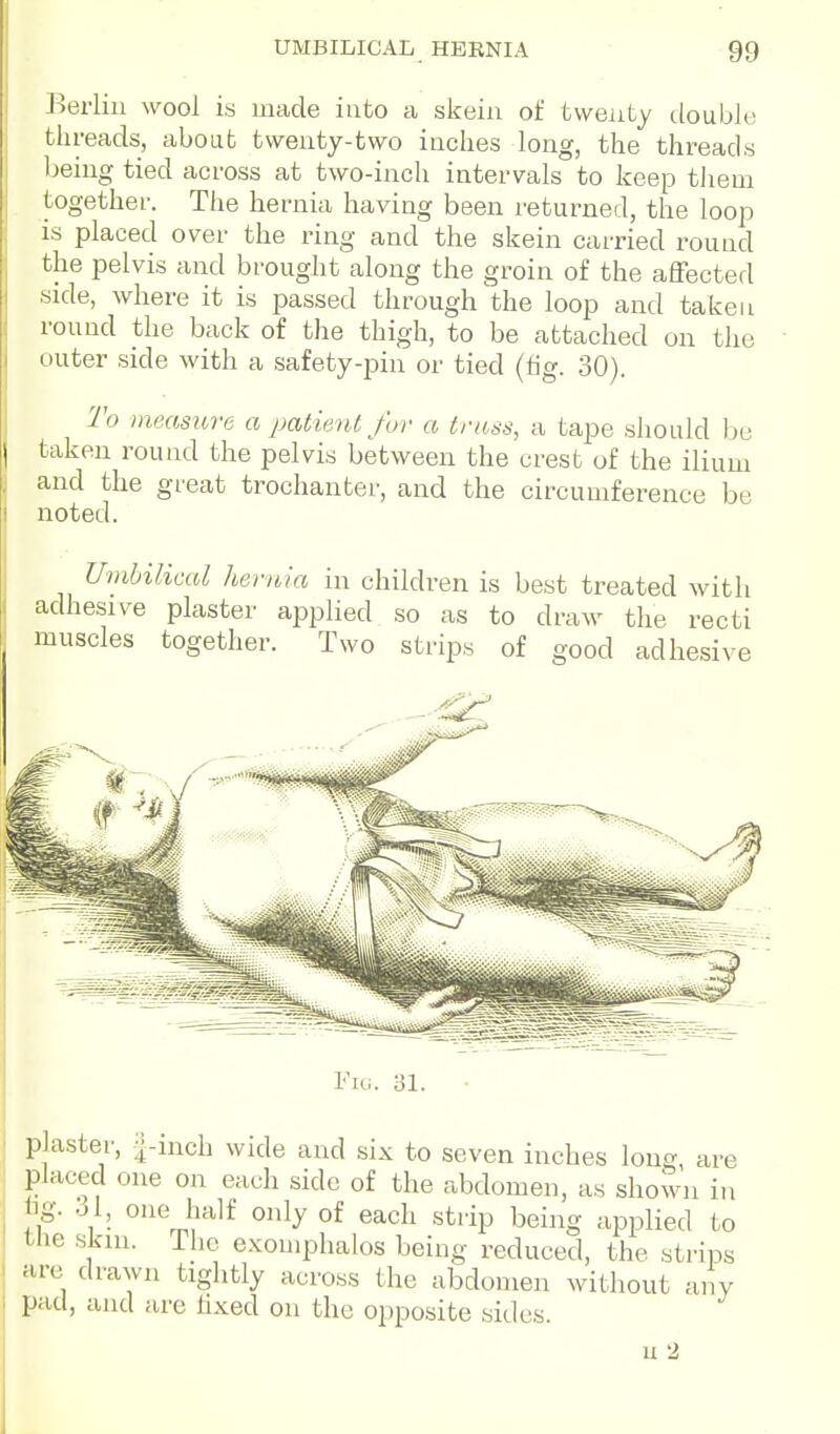 l^erlin wool is made into a skeiii of twenty ilouble threads, about tvveuty-two inches long, the threads being tied across at two-inch intervals to keep tliem together. The hernia having been I'eturned, the loop is placed over the ring and the skein carried round the pelvis and brought along the groin of the affected side, where it is passed through'the loop and taken round the back of the thigh, to be attached on the outer side with a safety-pin or tied (tig. 30). 2'o meastire a patient fur a trass, a tape should lie \ taken round the pelvis between the crest of the ilium and the great trochanter, and the circumference be noted. Umbilical hernia in children is best treated Avitli adhesive plaster applied so as to draw the recti muscles together. Two strips of good adhesive Fiu. 31. • plaster, i-mch wide and six to seven inches long are placed one on each side of the abdomen, as shown in hg. ol, one half only of each strip being applied to the skin. The e.Komphalos being reduced, the strips are drawn tightly across the abdomen without any pad, and are hxed on the opposite sides. u 2
