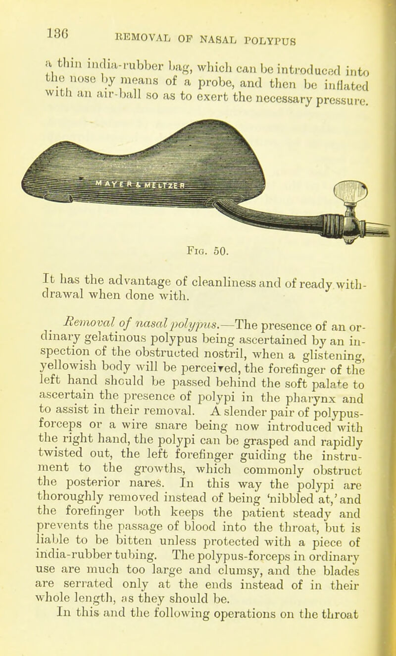 BEMOVAL OP NASAL POLYPUS a thm india-rubber ba- which can be inti-oducad into tlio nose l)y means of a probe, and then be inflated With an au--ball so as to exert the necessary pressure Fig. 50. It has the advantage of cleanliness and of ready with- drawal when done with. Removal of nasal polypus.—The presence of an or- dniary gelatinous polypus being ascertained by an in- spection of the obstructed nostril, when a glistenino-, yellowish body will be perceired, the forefinger of the left hand should be passed behind the soft palate to ascertain the presence of polypi in the pharynx and to assist in their removal. A slender pair of polypus- forceps or a wire snare being now introduced with the right hand, the polypi can be grasped and rapidly twisted out, the left forefinger guiding the instru- ment to the growtlis, which commonly obstruct the posterior nares. In this way the polypi are thoroughly removed instead of being 'nibbled at,'and the forefinger both keeps the patient steady and prevents the passage of blood into the throat, but is liable to be bitten unless protected Avith a piece of india-rubber tubing. The polypus-forceps in ordinary use are much too large and clumsy, and the blades are serrated only at the ends instead of in their whole lengtl), as they should be. In this and the following operations on the throat