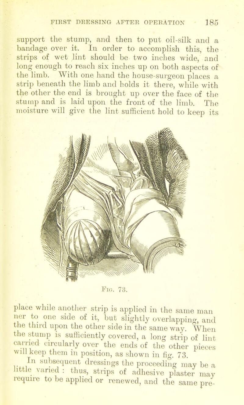 support the stump, and then to put oil-silk and a bandage over it. In order to accomplish this, the strips of wet lint should be two inches wide, and long enough to reach six inches up on both aspects of the limb. With one hand the house-surgeon places a strip beneath the limb and holds it there, while with the other the end is brought up over the face of the stump and is laid upon the front of the limb. The moisture will give the lint sufficient hold to keep its 73. place while another strip is applied in the same man ner to one side of it, but slightly overlapping, and the third upon the other side in the same way. When the stump is sufficiently covered, a long strip of lint earned circularly over the ends of the other pieces will keep them lu position, as shown in fig. 73. In subsequent dressings the proceeding may be a little varied : thus, strips of adhesive plaster may require to be applied or renewed, and the same pre-