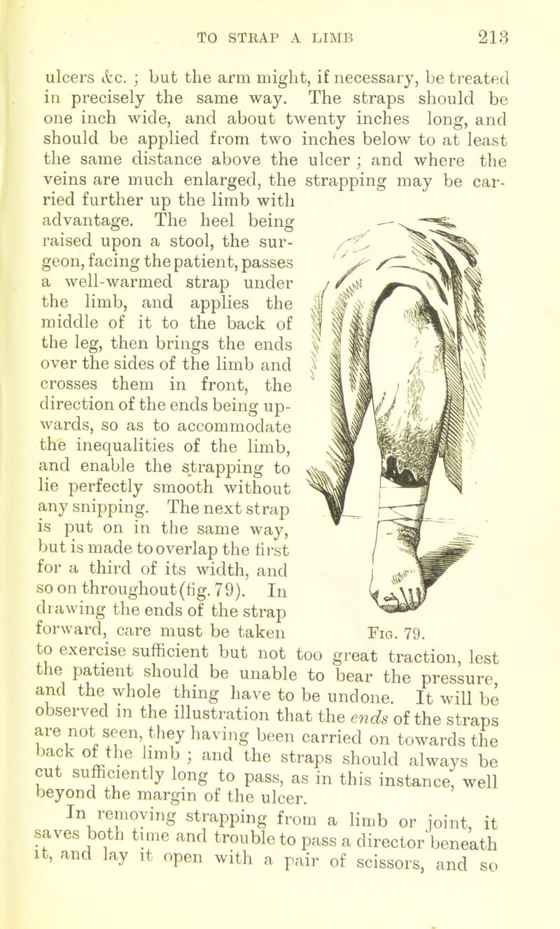 ulcers etc. ; but the arm might, if necessary, be treated in precisely the same way. The straps should be one inch wide, and about twenty inches long, and should be applied from two inches below to at least the same distance above the ulcer ; and where the veins are much enlarged, the strapping may be car- ried further up the limb with advantage. The heel being raised upon a stool, the sur- geon, facing the patient, passes a well-warmed strap under the limb, and applies the middle of it to the back of the leg, then brings the ends over the sides of the limb and crosses them in front, the direction of the ends being up- wards, so as to accommodate the inequalities of the limb, and enable the strapping to lie perfectly smooth without any snipping. The next strap is put on in the same way, but is made to overlap the tii-st for a third of its width, and so on throughout (fig. 79). In di awing the ends of the strap forward, care must be taken to exercise sufficient but not too great traction, lest the patient should be unable to bear the pressure and the whole thing have to be undone. It will be observed m the illustration that the ends of the straps are not seen, they having been carried on towards the back of the hmb ; and the straps should always be cut sufficiently long to pass, as in this instance, well beyond the margin of the ulcer. In removing strapping from a limb or joint, it saves both tune and trouble to pass a directorbeneath It, and lay it open with a pair of scissors, and so