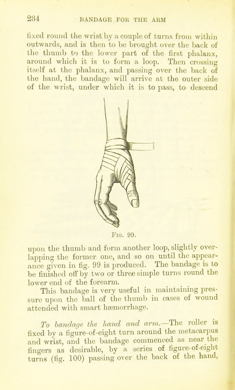 fixed round the wrist by ;i couple of tui'iis from within outwards, and is then to be brought over the back of tlie tliunib to the lower part of the first phalanx, around which it is to form a loop. Then crossing itself at the phalanx, and passing over the back of the hand, the bandage will arrive at the outer side of the wrist, under which it is to pass, to descend Fig. 99. upon the thumb and form another loop, slightly over- lapping the formei'- one, and so on until the appear- ance given in fig. 99 is produced. The bandage is to be finished off by two or three simple turns round the lower end of the forearm. This bandage is very useful in maintaining pres- sure upon the ball of the thumb in cases of wound attended with smart haemorrhage. To bandage the hand and arm.—The roller is fixed by a figure-of-eight turn around the metacarpus and wrist, and the bandage commenced as near the fingers as desirable, by a series of figure-of-eiglit turns (fig. 100) passing over the back of the hand,