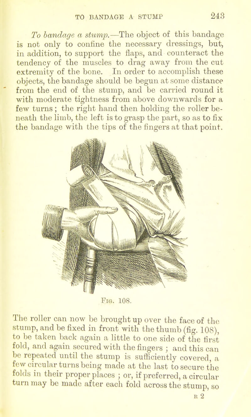 To bandage a stumjx—The object of this bandage is not only to confine the necessary dressings, but, in addition, to support tlie flaps, and counteract the tendency of the muscles to drag away from the cut extremity of the bone. In order to accomplish these objects, the bandage should be begun at some distance from the end of the stump, and be carried round it with moderate tightness from above downwards for a few turns ; the right hand then holding the roller be- neath the limb, the left is to grasp the part, so as to fix the bandage with the tips of the fingers at that point. Fig. 108. The roller can now be brought up over the face of the stump, and be fixed in front with the thumb (fig. 108), to be taken back again a little to one side of the first fold, and again secured with the fingers ; and this can be repeated until the stump is sufliciently covered, a few circular turns being made at the last to secure the folds in their proper places ; or, if preferred, a circular turn may be made after each fold across the stump, so K 2