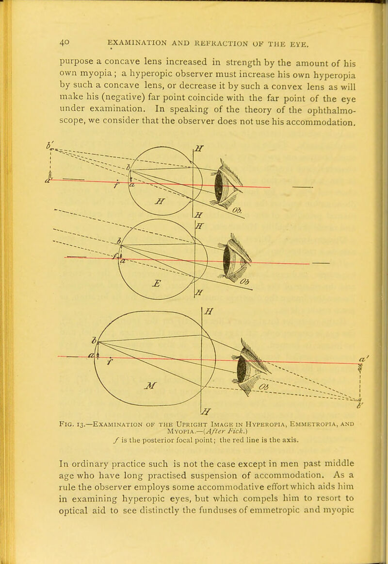 purpose a concave lens increased in strength by the amount of his own myopia; a hyperopia observer must increase his own hyperopia by such a concave lens, or decrease it by such a convex lens as will make his (negative) far point coincide with the far point of the eye under examination. In spealcing of the theory of the ophthalmo- scope, we consider that the observer does not use his accommodation. In ordinary practice such is not the case except in men past middle age who have long practised suspension of accommodation. As a rule the observer employs some accommodative effort which aids him in examining hyperopia eyes, but which compels him to resort to optical aid to see distinctly the fundusesof emmetropic and myopic