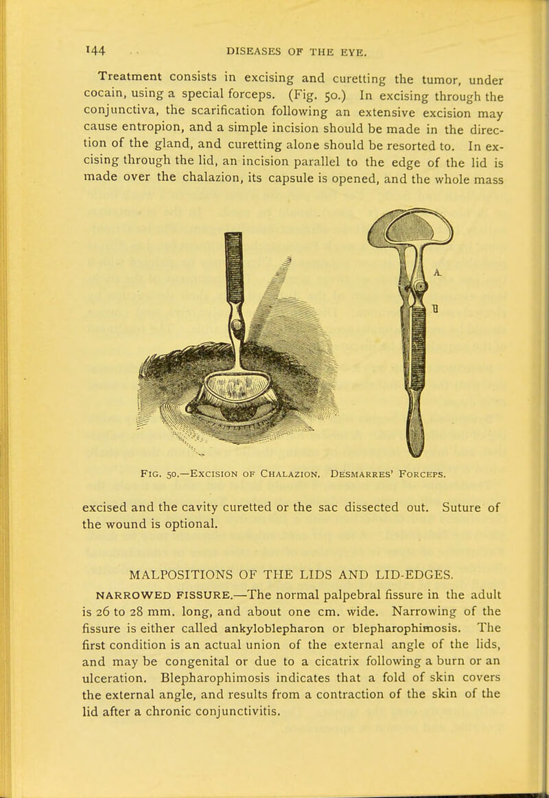 Treatment consists in excising and curetting the tumor, under cocain, using a special forceps. (Fig. 50.) In excising through the conjunctiva, the scarification following an extensive excision may- cause entropion, and a simple incision should be made in the direc- tion of the gland, and curetting alone should be resorted to. In ex- cising through the lid, an incision parallel to the edge of the lid is made over the chalazion, its capsule is opened, and the whole mass Fig. 50.—Excision of Chalazion. Desmarres' Forceps. excised and the cavity curetted or the sac dissected out. Suture of the wound is optional. MALPOSITIONS OF THE LIDS AND LID-EDGES. NARROWED FISSURE.—The normal palpebral fissure in the adult is 26 to 28 mm. long, and about one cm. wide. Narrowing of the fissure is either called ankyloblepharon or blepharophimosis. The first condition is an actual union of the external angle of the lids, and may be congenital or due to a cicatrix following a burn or an ulceration. Blepharophimosis indicates that a fold of skin covers the external angle, and results from a contraction of the skin of the lid after a chronic conjunctivitis.