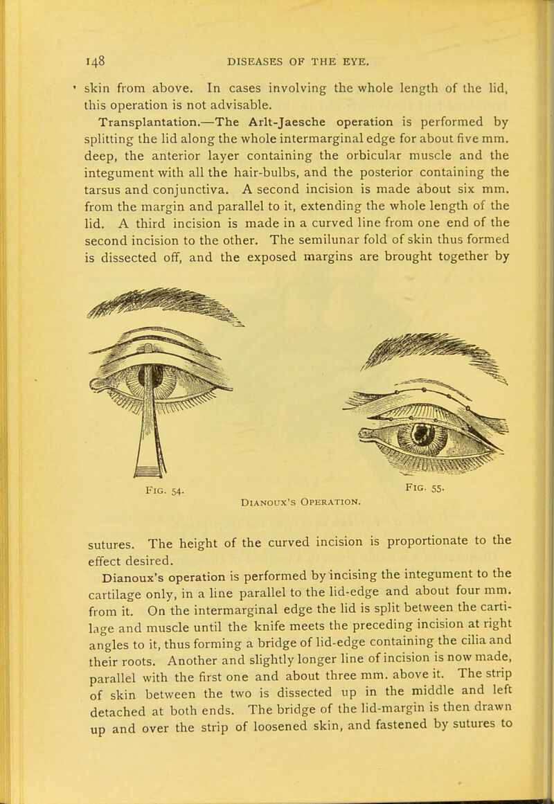 ' skin from above. In cases involving the whole length of the lid, this operation is not advisable. Transplantation.—The Arlt-Jaesche operation is performed by splitting the lid along the whole intermarginal edge for about five mm. deep, the anterior layer containing the orbicular muscle and the integument with all the hair-bulbs, and the posterior containing the tarsus and conjunctiva. A second incision is made about six mm. from the margin and parallel to it, extending the whole length of the lid. A third incision is made in a curved line from one end of the second incision to the other. The semilunar fold of skin thus formed is dissected off, and the exposed margins are brought together by sutures. The height of the curved incision is proportionate to the effect desired. Dianoux's operation is performed by incising the integument to the cartilage only, in a hne parallel to the lid-edge and about four mm. from it. On the intermarginal edge the lid is split between the carti- lage and muscle until the knife meets the preceding incision at right angles to it, thus forming a bridge of lid-edge containing the cilia and their roots. Another and shghtly longer line of incision is now made, parallel with the first one and about three mm. above it. The strip of skin between the two is dissected up in the middle and left detached at both ends. The bridge of the lid-margin is then drawn up and over the strip of loosened skin, and fastened by sutures to