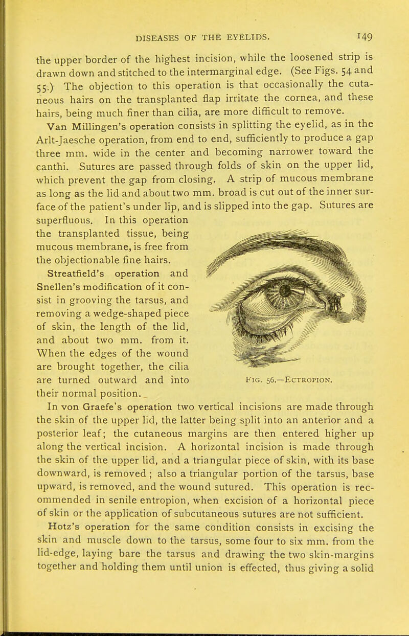 the upper border of the highest incision, while the loosened strip is drawn down and stitched to the intermarginal edge. (See Figs. 54 and 55.) The objection to this operation is that occasionally the cuta- neous hairs on the transplanted flap irritate the cornea, and these hairs, being much finer than cilia, are more difficult to remove. Van Millingen's operation consists in splitting the eyelid, as in the Arlt-Jaesche operation, from end to end, sufficiently to produce a gap three mm. wide in the center and becoming narrower toward the canthi. Sutures are passed through folds of skin on the upper lid, which prevent the gap from closing. A strip of mucous membrane as long as the lid and about two mm. broad is cut out of the inner sur- face of the patient's under lip, and is slipped into the gap. Sutures are superfluous. In this operation the transplanted tissue, being mucous membrane, is free from the objectionable fine hairs. Streatfield's operation and Snellen's modification of it con- sist in grooving the tarsus, and removing a wedge-shaped piece of skin, the length of the lid, and about two mm. from it. When the edges of the wound are brought together, the cilia are turned outward and into their normal position. In von Graefe's operation two vertical incisions are made through the skin of the upper lid, the latter being split into an anterior and a posterior leaf; the cutaneous margins are then entered higher up along the vertical incision. A horizontal incision is made through the skin of the upper lid, and a triangular piece of skin, with its base downward, is removed ; also a triangular portion of the tarsus, base upward, is removed, and the wound sutured. This operation is rec- ommended in senile entropion, when excision of a horizontal piece of skin or the application of subcutaneous sutures are not sufficient. Hotz's operation for the same condition consists in excising the skin and muscle down to the tarsus, some four to six mm. from the lid-edge, laying bare the tarsus and drawing the two skin-margins together and holding them until union is eff'ected, thus giving a solid Fig. 56.—Ectropion.