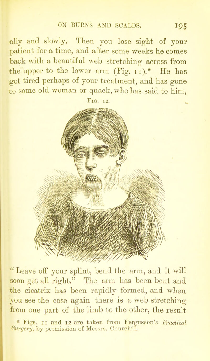 ftUy and slowly. Then you lose siglit of your patient for a time, and after some weeks he comes back with a beautiful web stretching across from the upper to the lower arm (Fig. ii).* He has got tired perhaps of your treatment, and has gone to some old woman or quack, who has said to him, Fig. 12. _ Leave off your splint, bend the arm, and it will soon get all right. The arm has been bent and the cicatrix has been rapidly formed, and when you see the case again there is a web stretching from one part of the limb to the other, the result * Figs. II and 12 are taken from Fergusson's Practical Surr/ery, by permission of Messrs. Churchill.