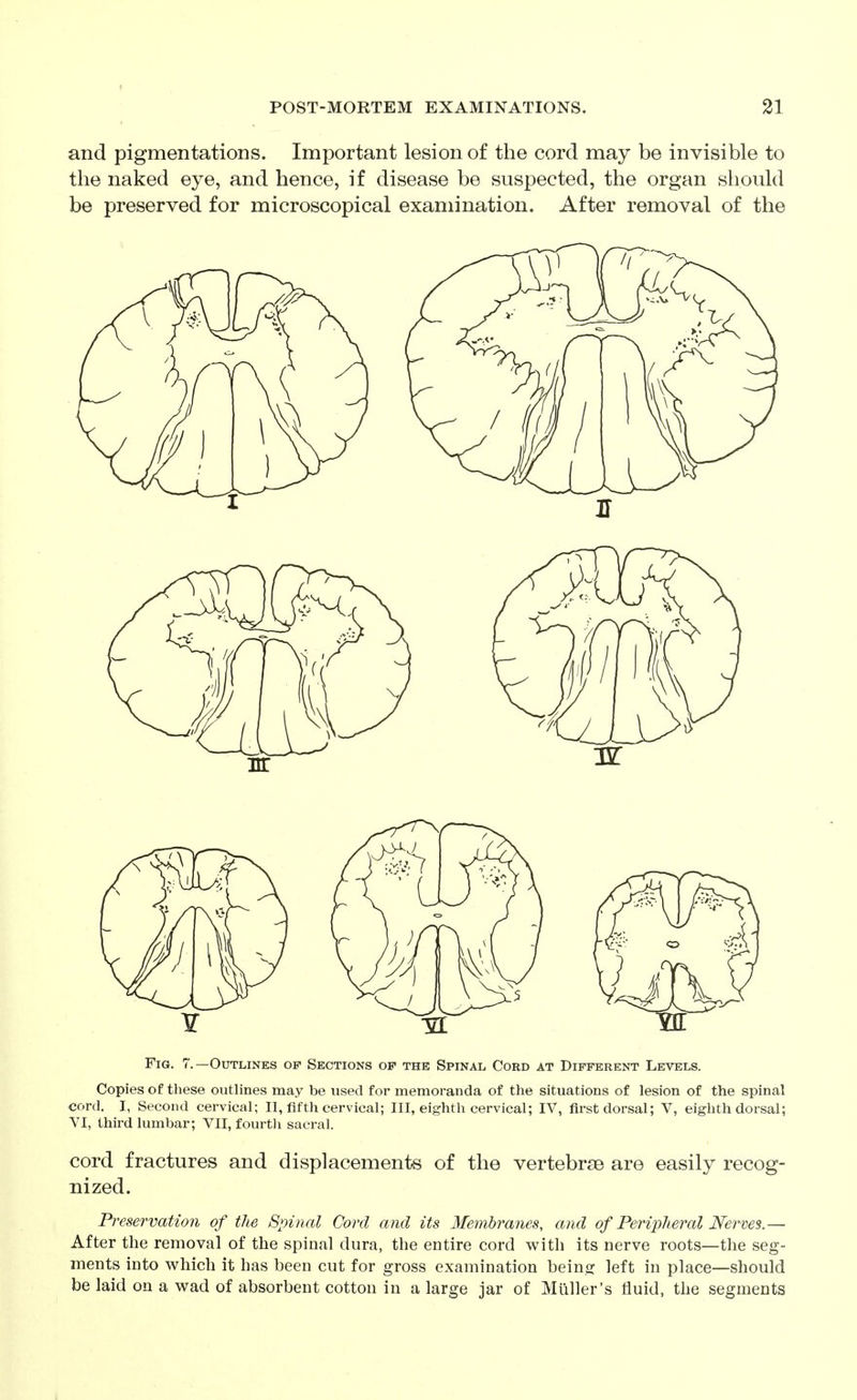 and pigmentations. Important lesion of the cord may be invisible to the naked eye, and hence, if disease be suspected, the organ should be preserved for microscopical examination. After removal of the Fig. 7.—Outlines of Sections of the Spinal Cord at Different Levels. Copies of these outlines may be used for memoranda of the situations of lesion of the spinal cord. I, Second cervical; H, fifth cervical; IH, eighth cervical; IV, first dorsal; V, eighth dorsal; VI, third lumbar; VII, fourth sacral. cord fractures and displacements of the vertebrse are easily recog- nized. Preservation of the Spinal Cord and its Membranes, and of Peripheral Nerves.— After the removal of the spinal dura, the entire cord with its nerve roots—the seg- ments into which it has been cut for gross examination being left in place—should be laid on a wad of absorbent cotton in a large jar of Muller's fluid, the segments